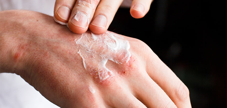 3 OTC Treatments for Contact Dermatitis
