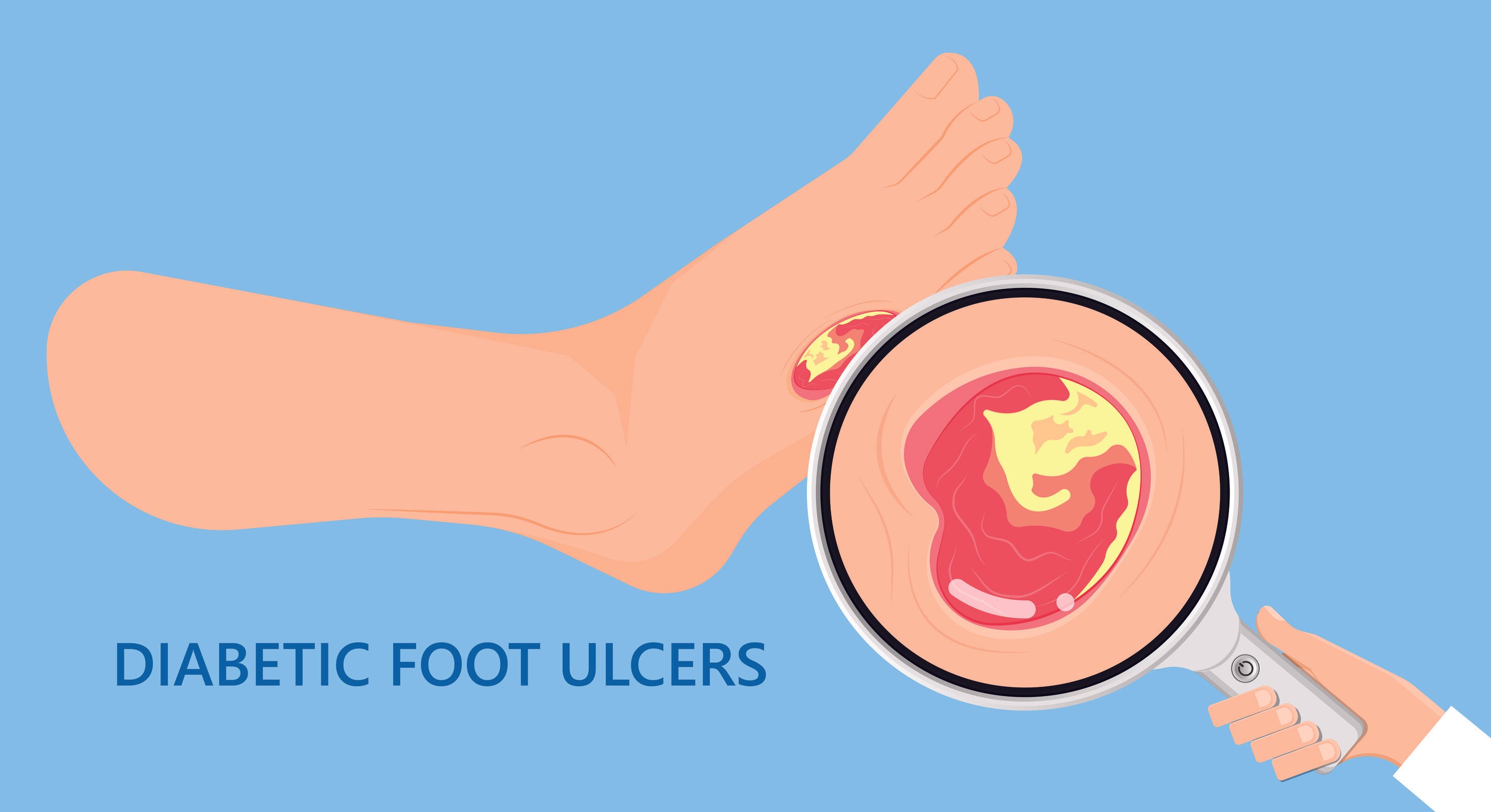 An overview of how diabetic foot wounds can be treated