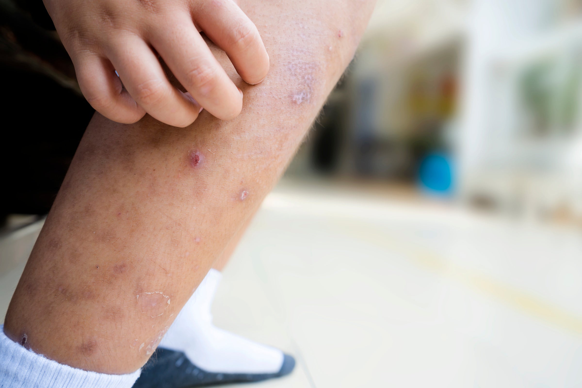 5 Methods For Preventing Insect Bites From Scarring