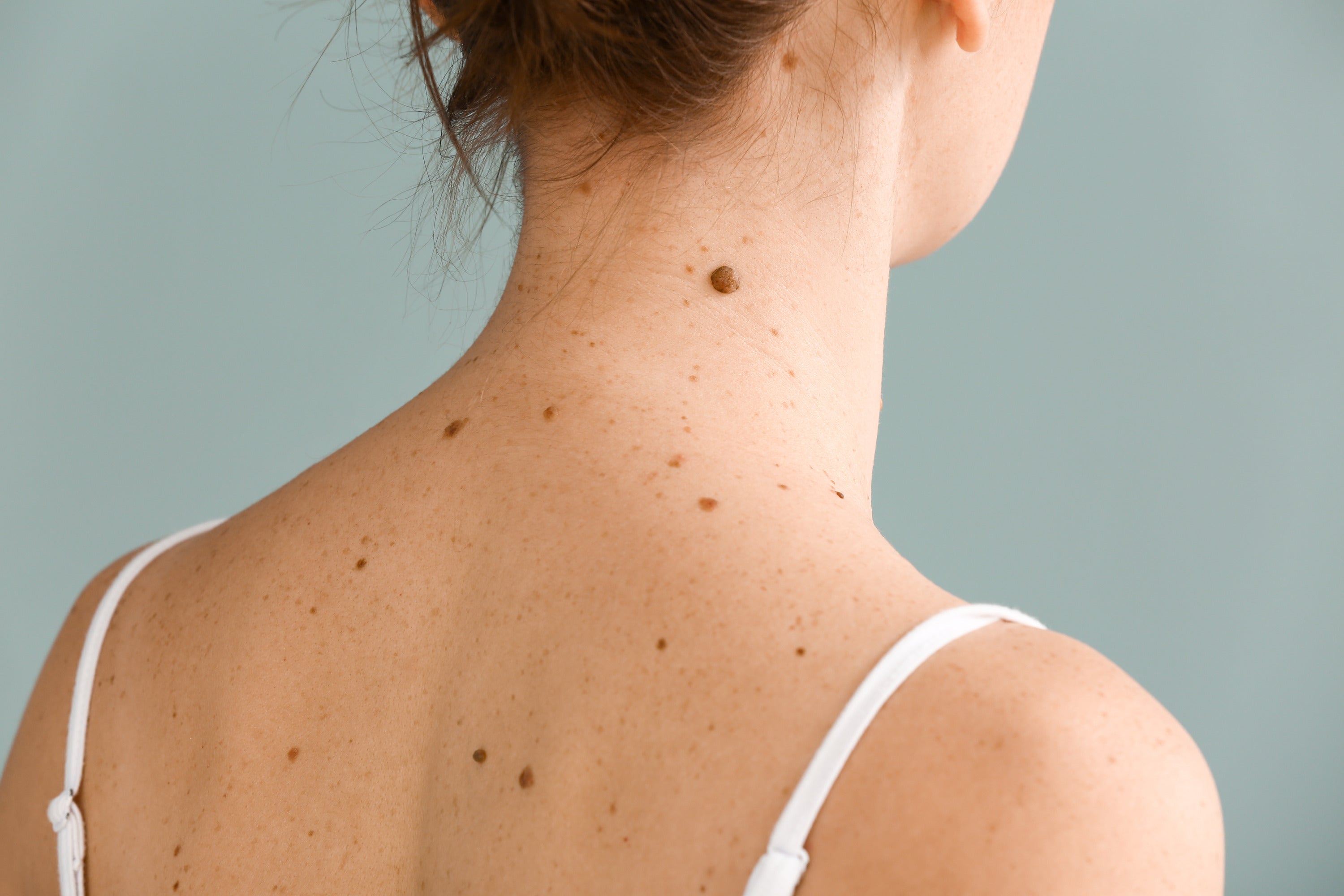 6 Preventions for Naturally Removing a Mole