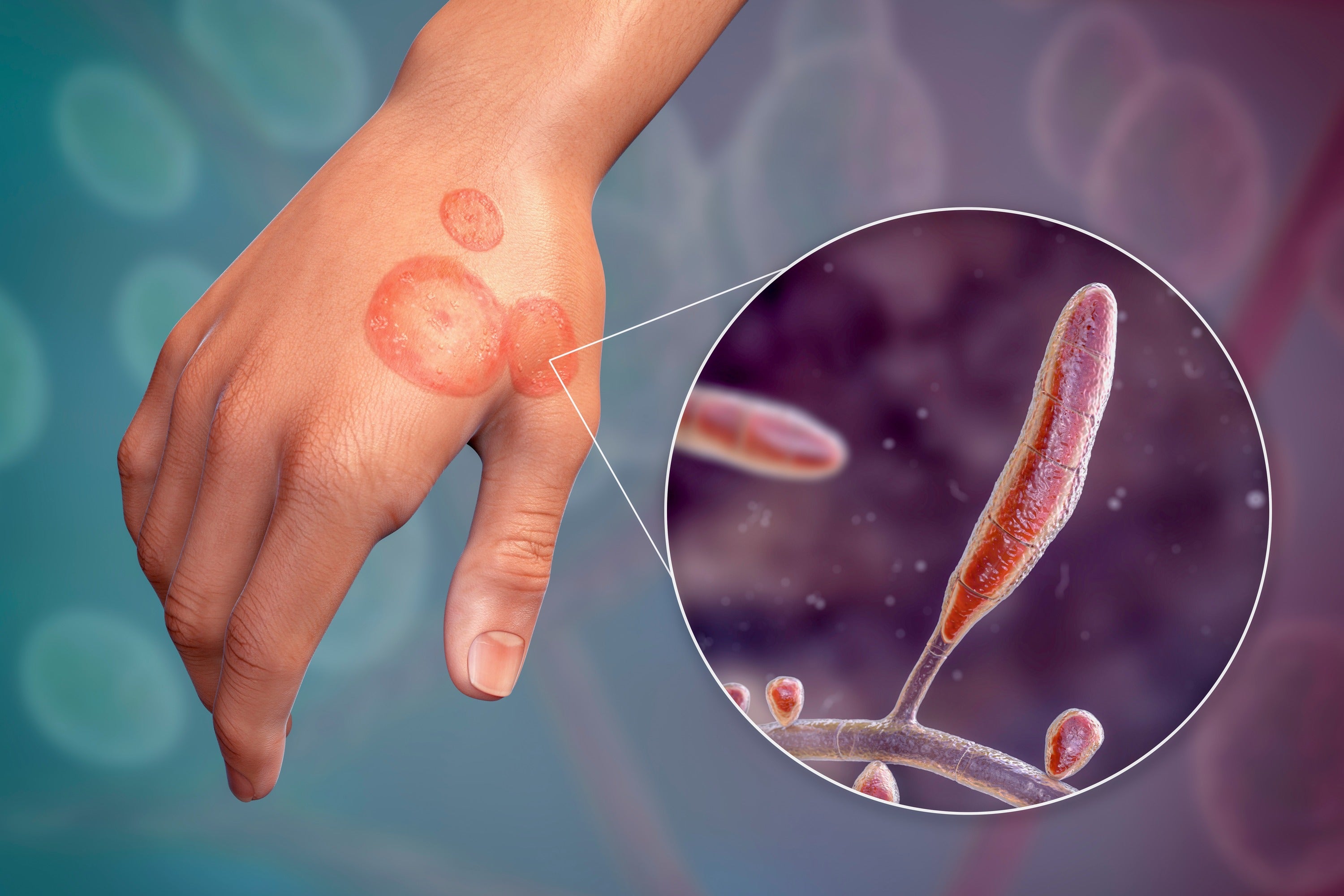 Diagnosis and Treatment Detecting Less Typical Fungi