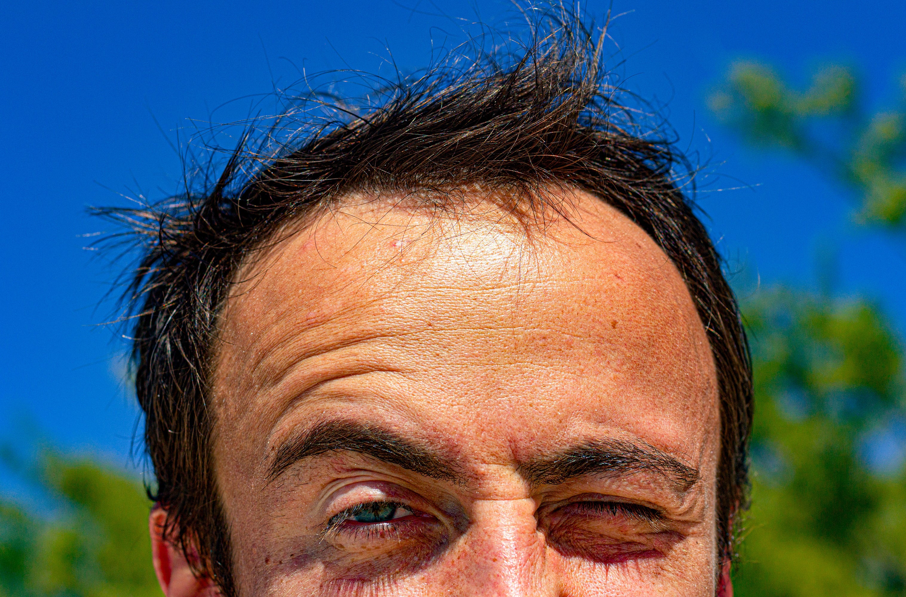 Indications of Serious Sunburn On The Scalp