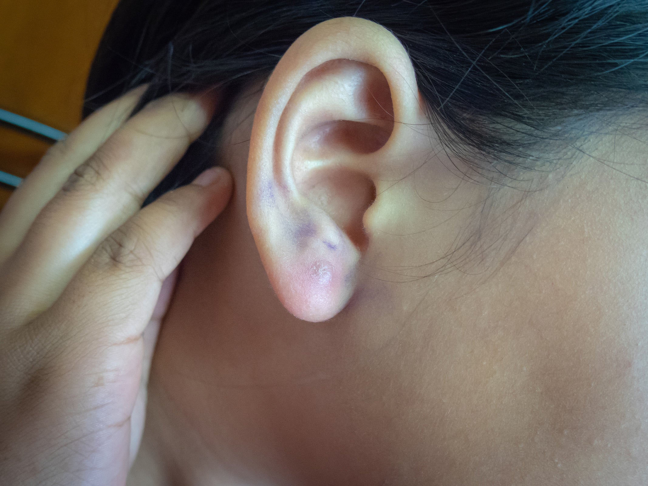Infection caused by ear piercing pain