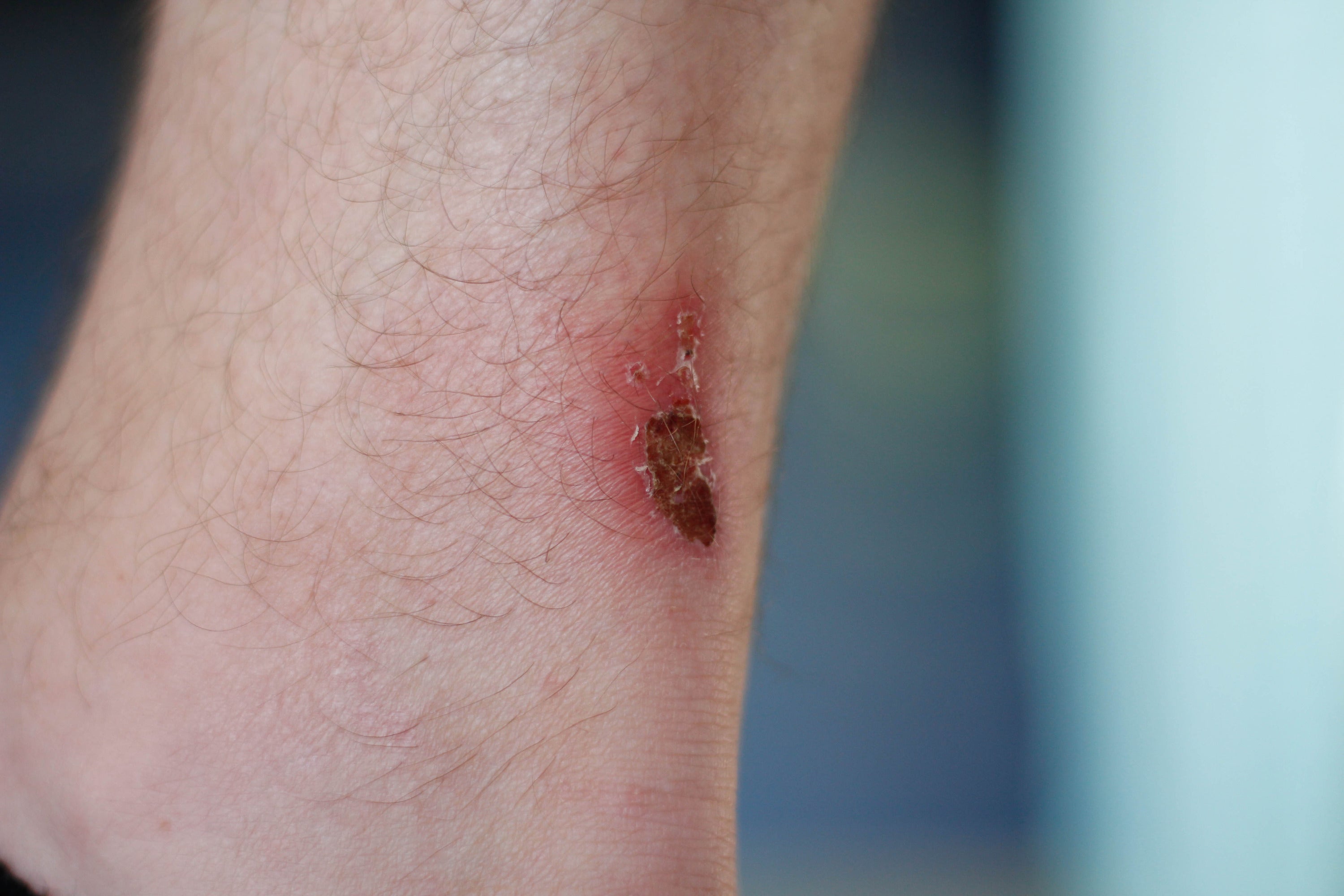 Third-Degree Burns Infection Complications