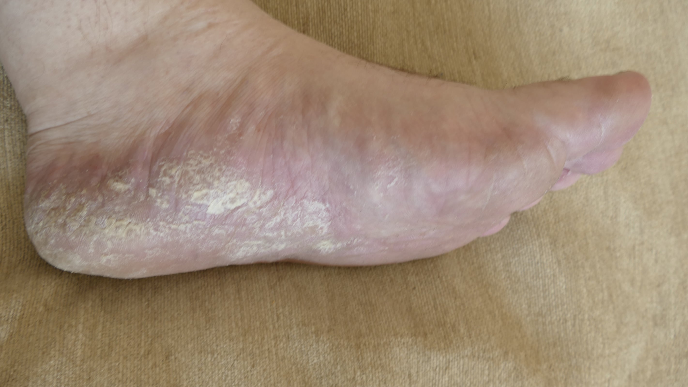 The Inflammatory Phase Of Diabetic Wound Healing