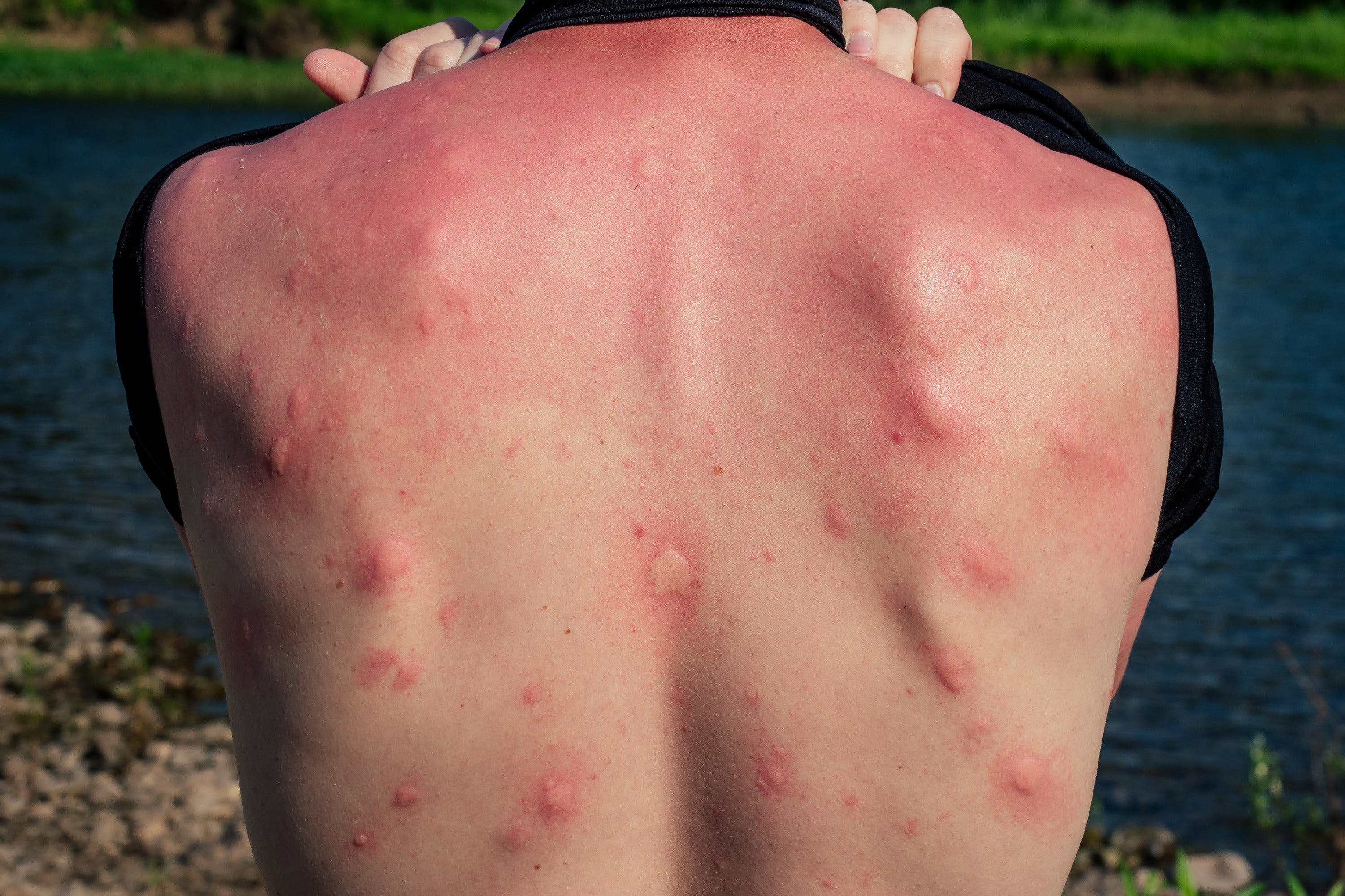 Understanding the causes of insect bites that cause muscle pain