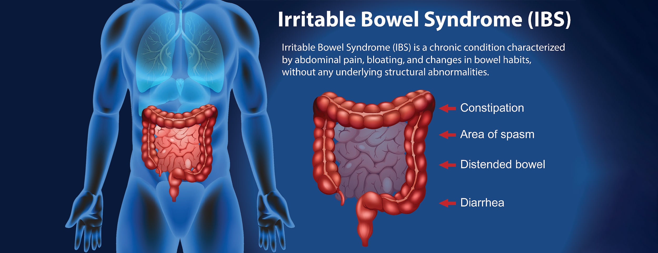 Irritable bowel syndrome associated with hemorrhoids mucus