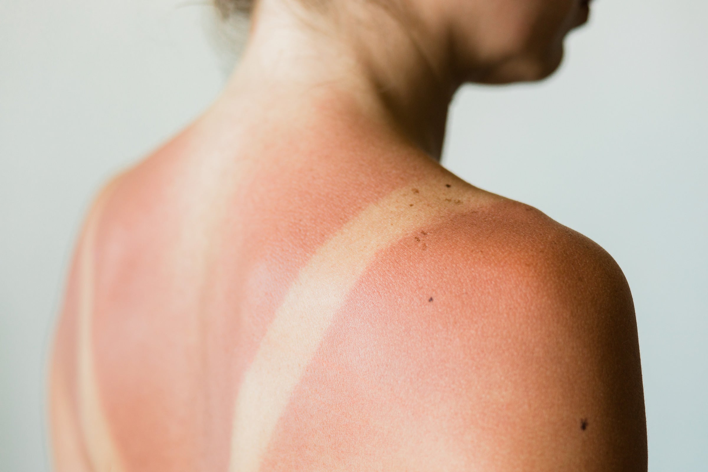 The 4 reasons you're more likely to get burned in summer