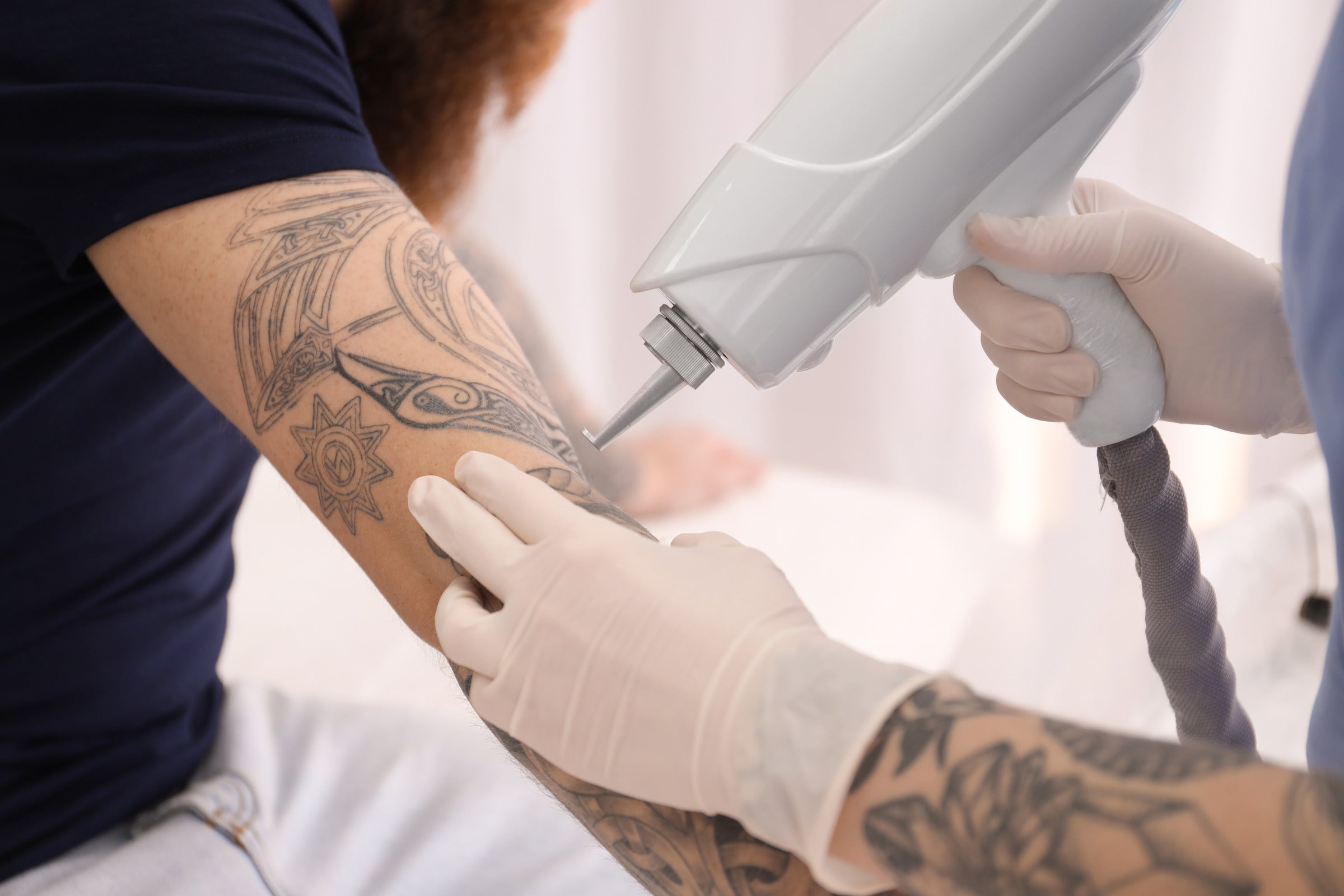 Mechanical and Chemical Methods to Remove Bad Tattoos at Home [DIY]