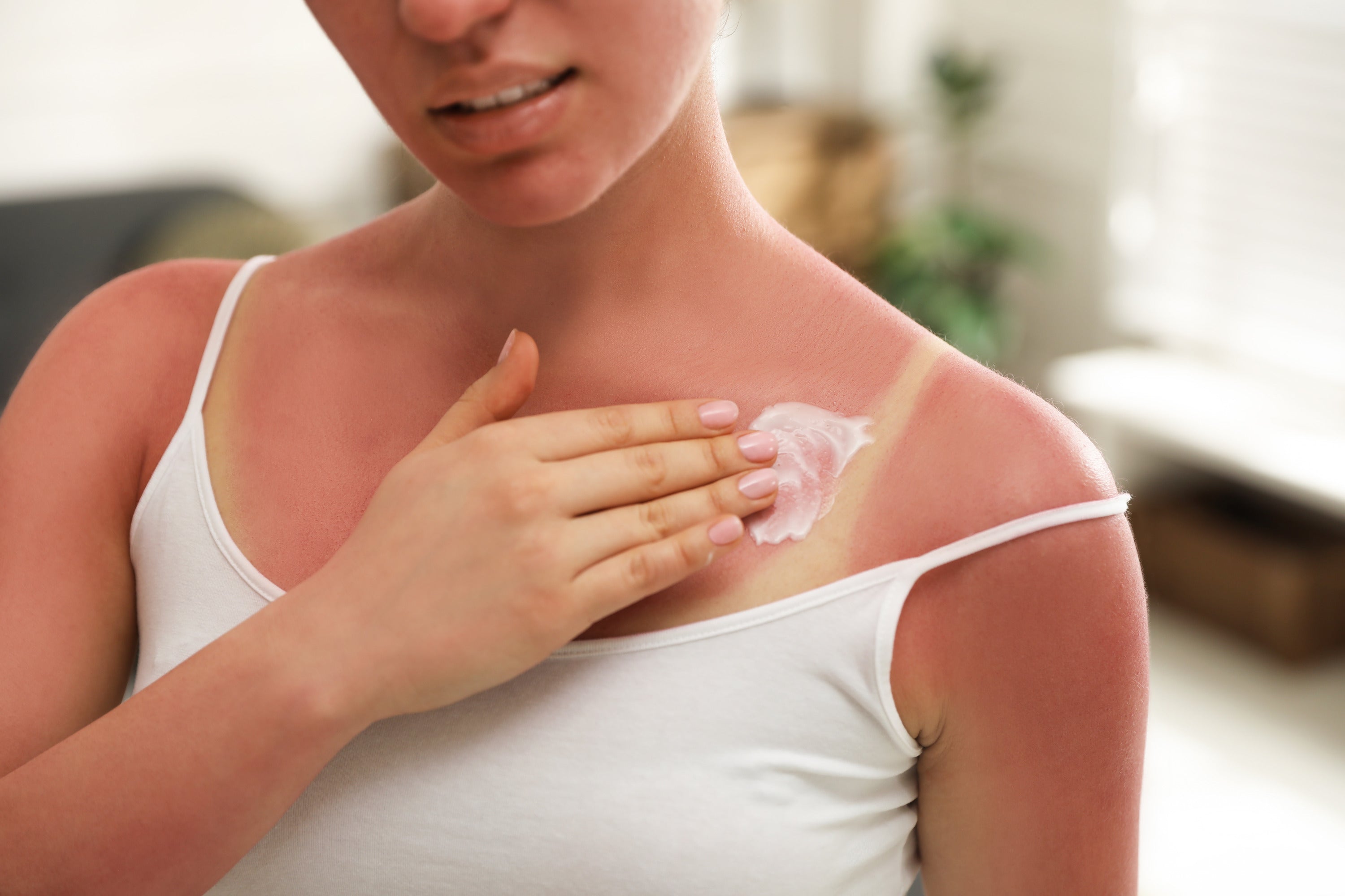 All you need to know about sunburn rash treatment