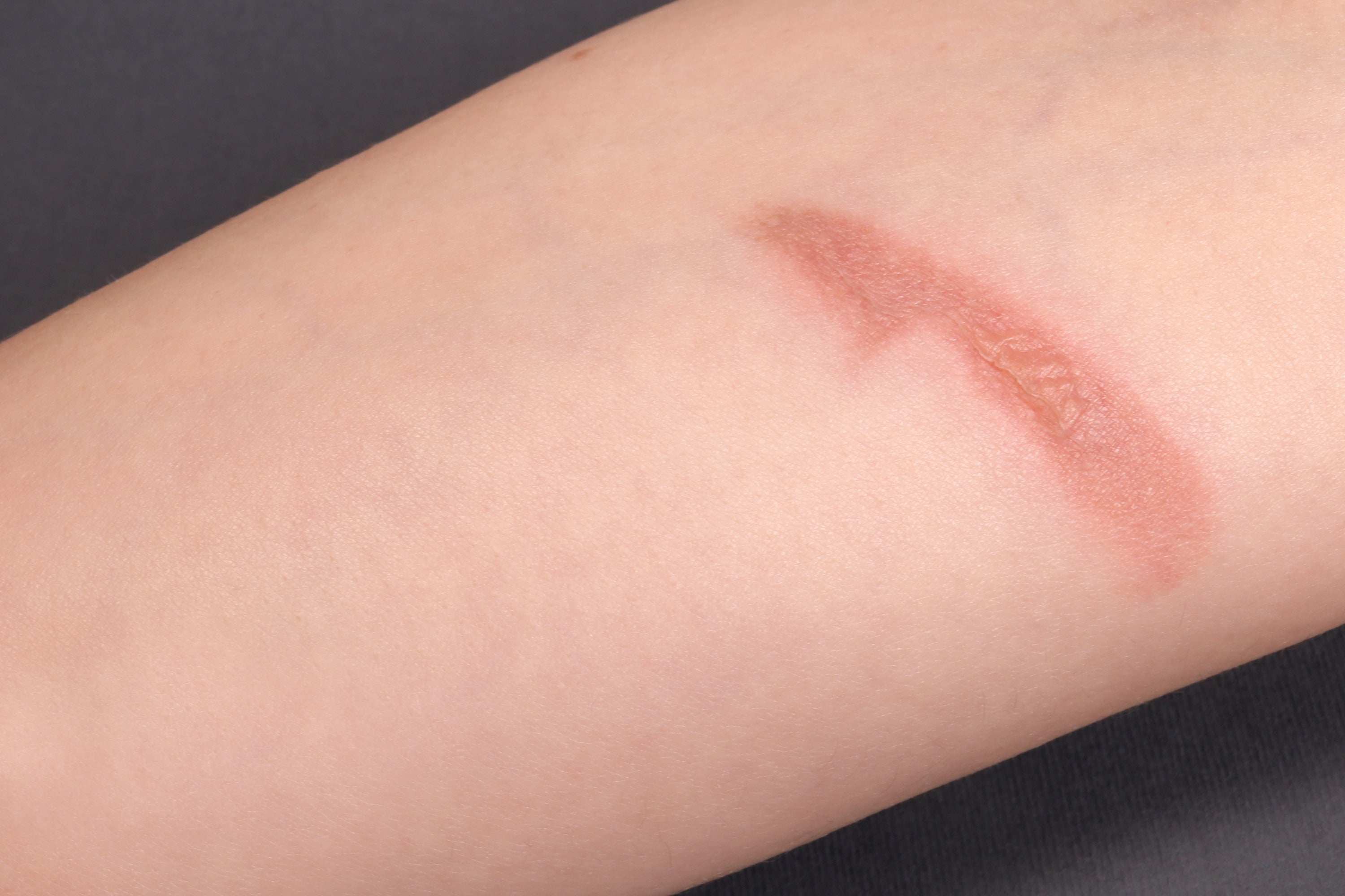 Recognizing and assessing second degree burns