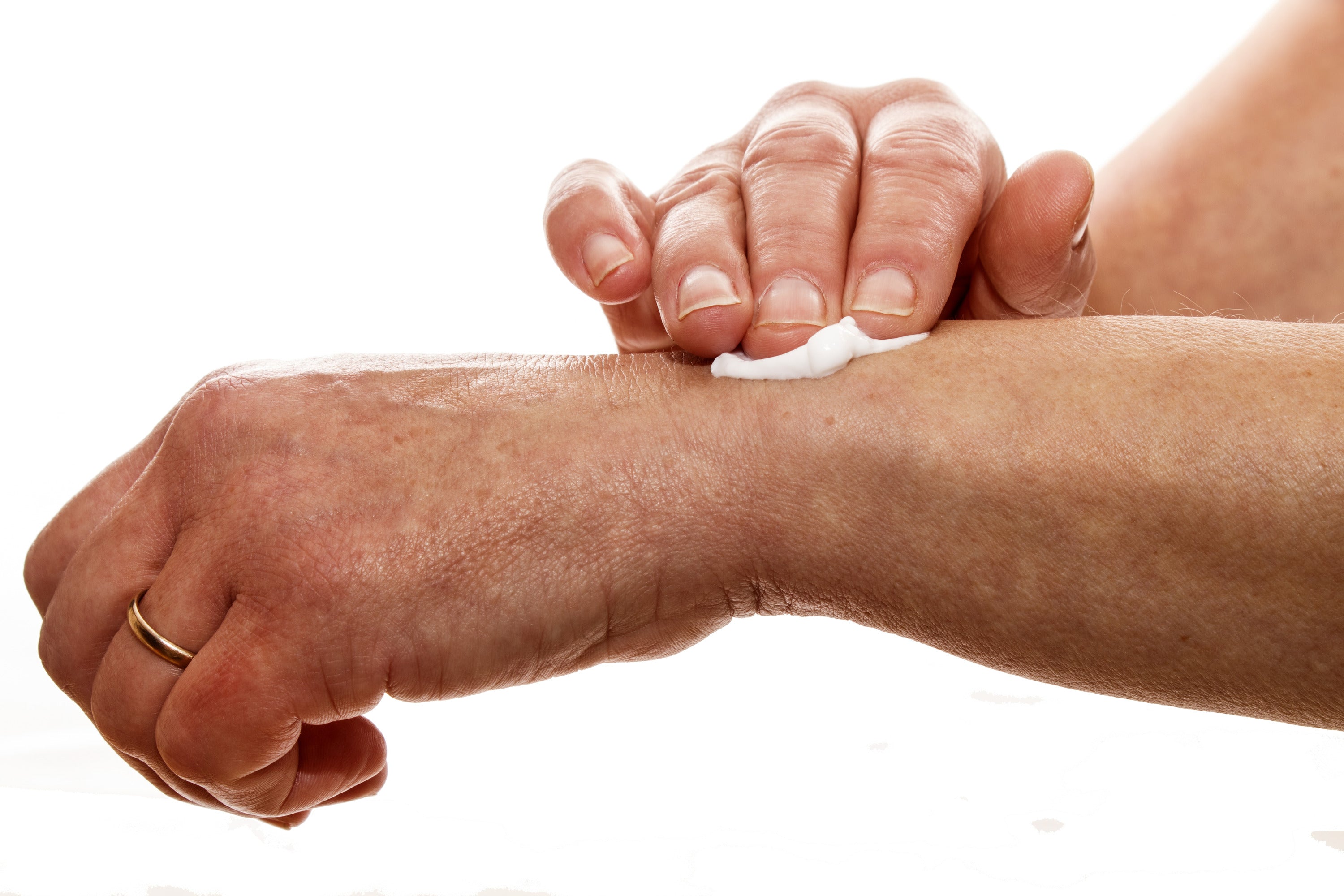 Pain relief from osteoarthritis with numbing cream