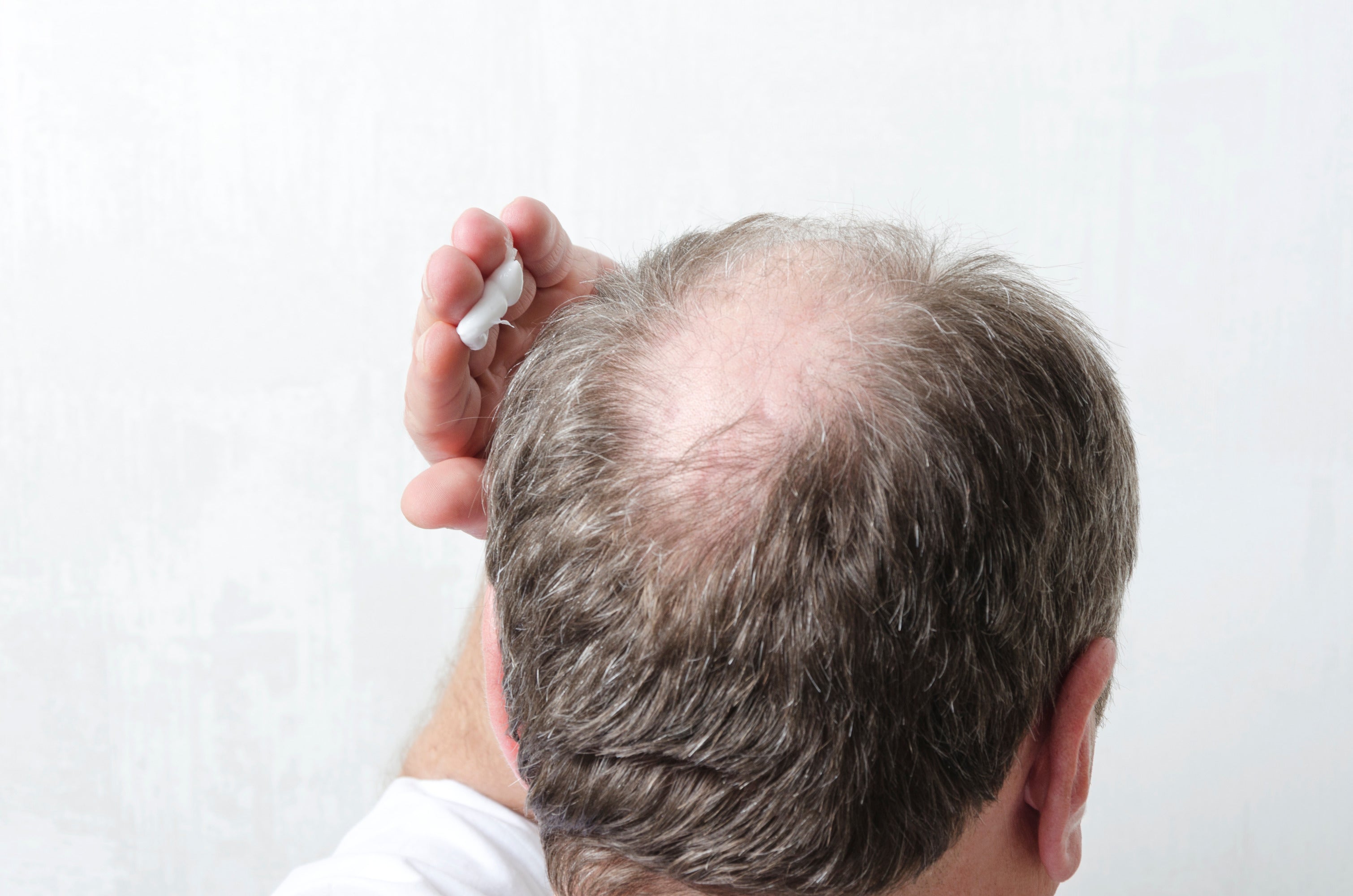 Relief from Sunburned Scalp Pain Over-the-Counter