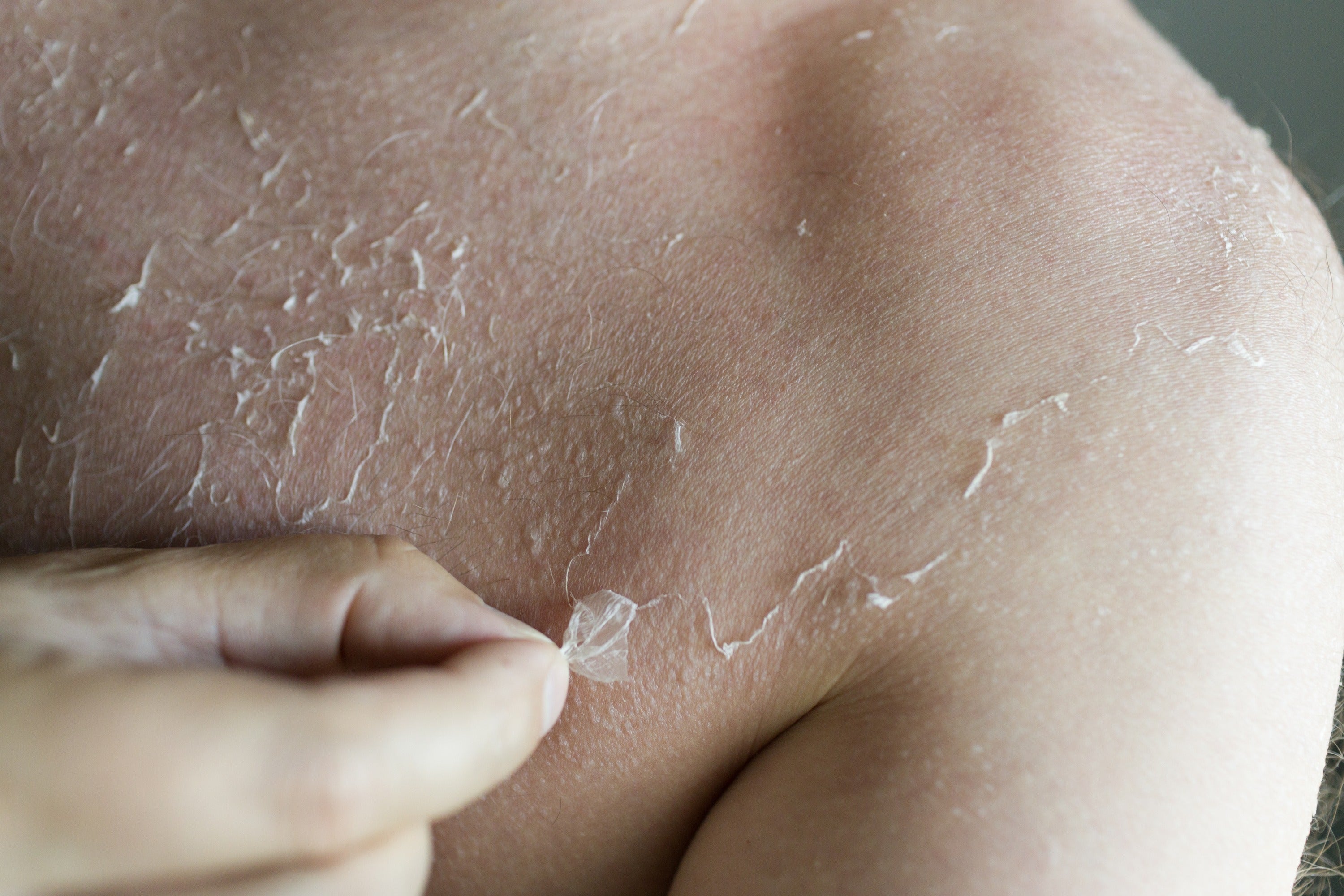 Choosing the right peeling sunburn treatment