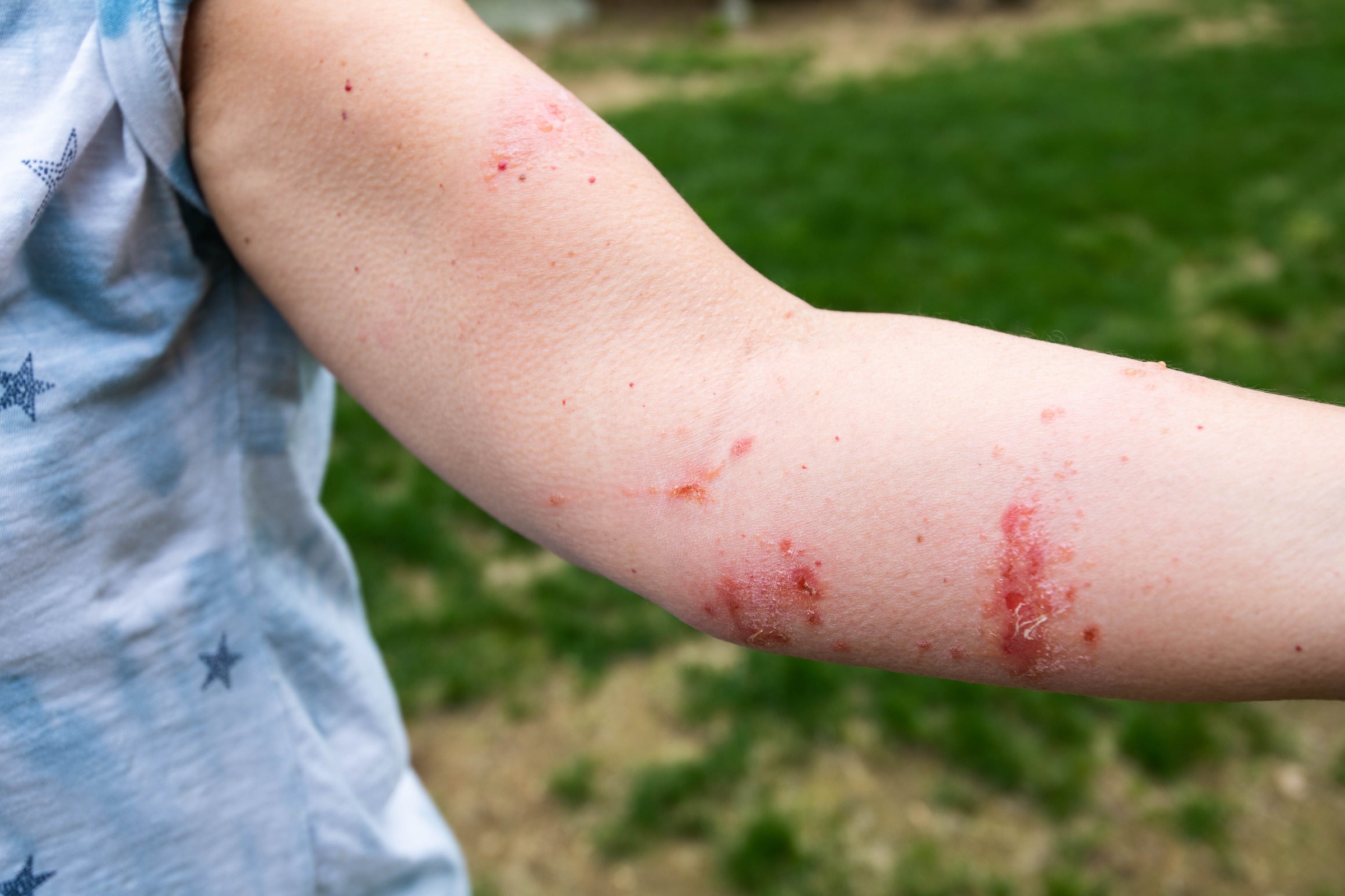 Rashes and blisters caused by plants: 5 common culprits