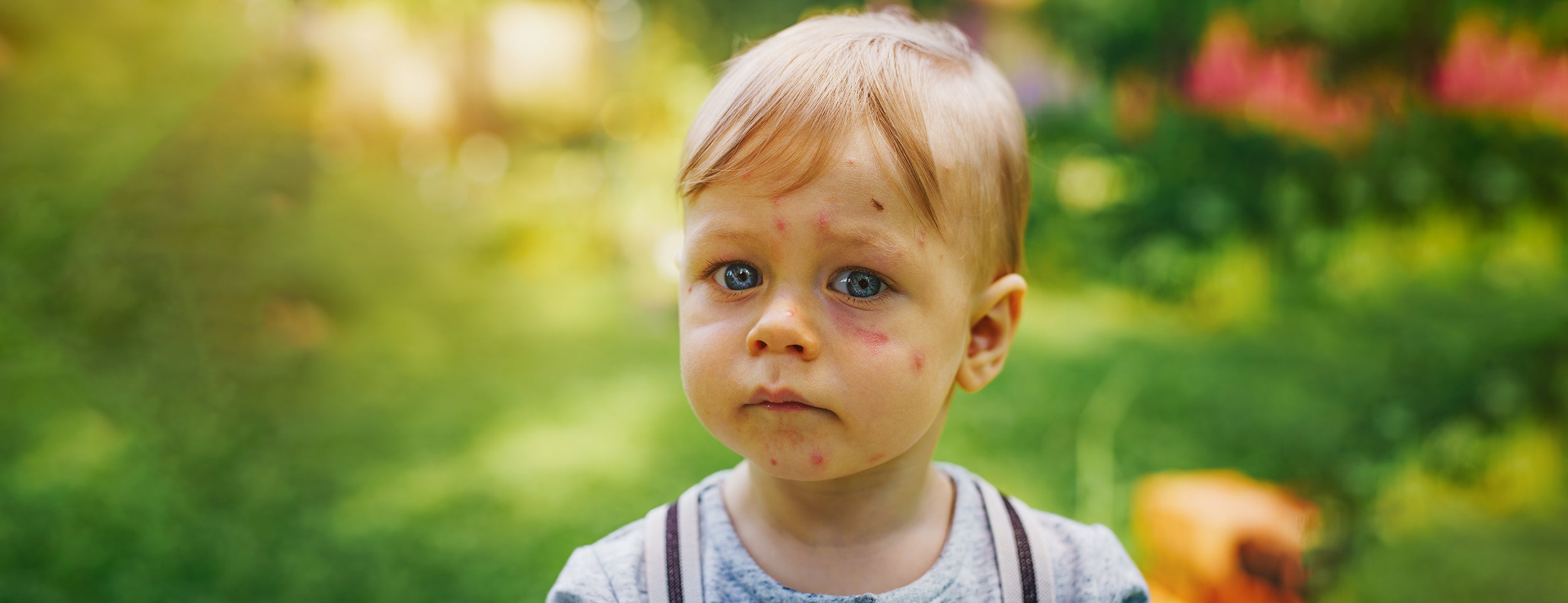 Preventative measures for reducing insect bite swelling on the face