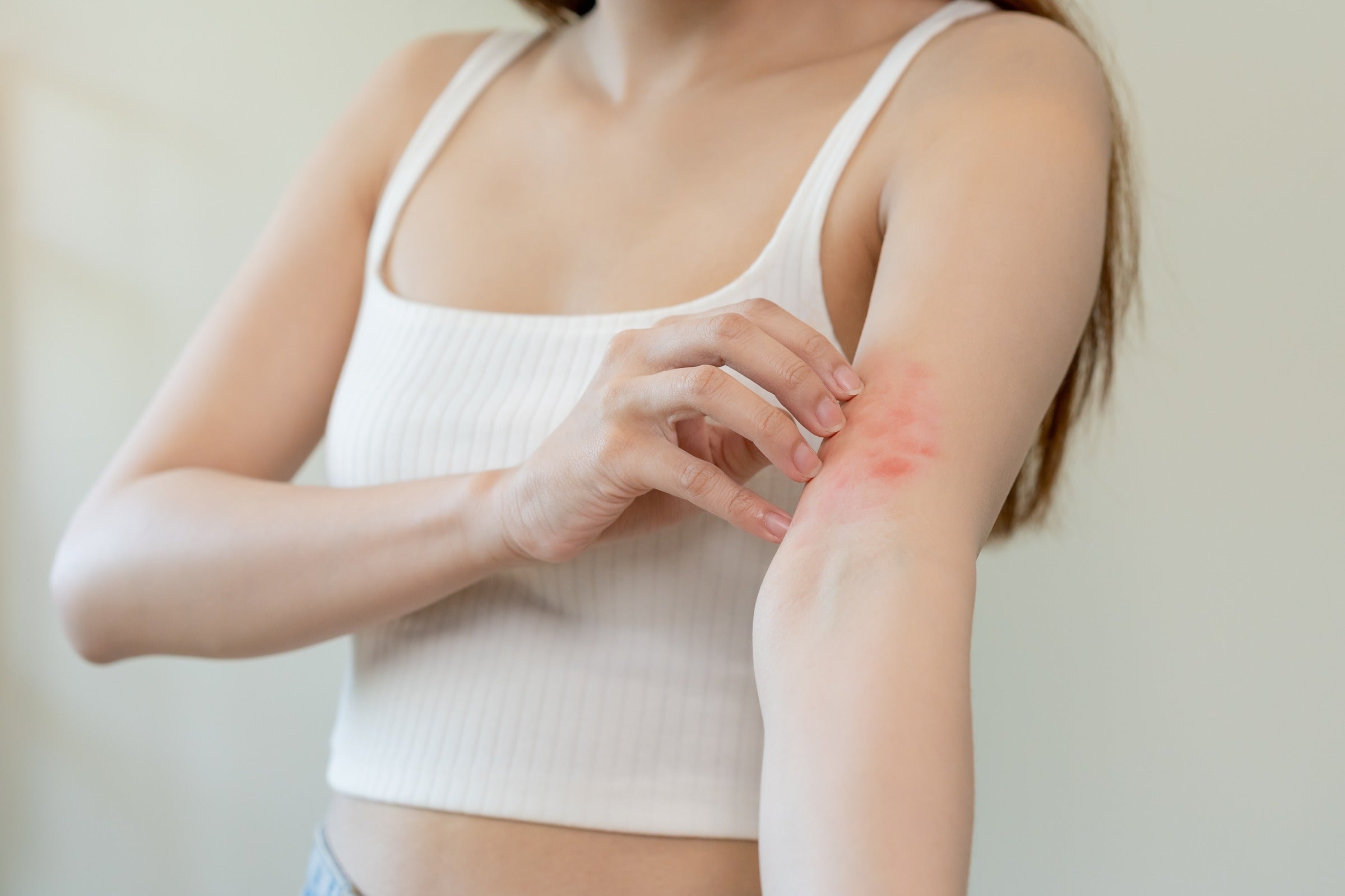 Insect Bite Bruising Prevention Tips