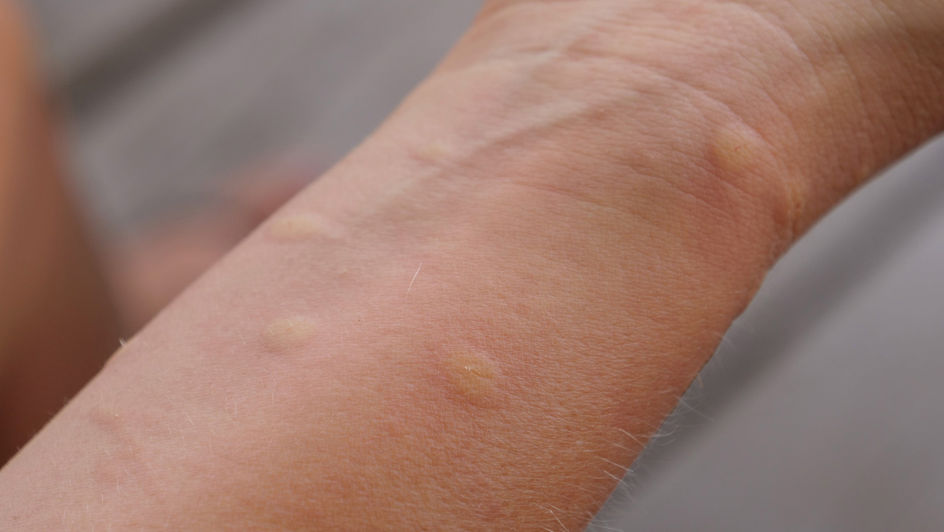 Insect bite allergies are caused by previous exposure and sensitization