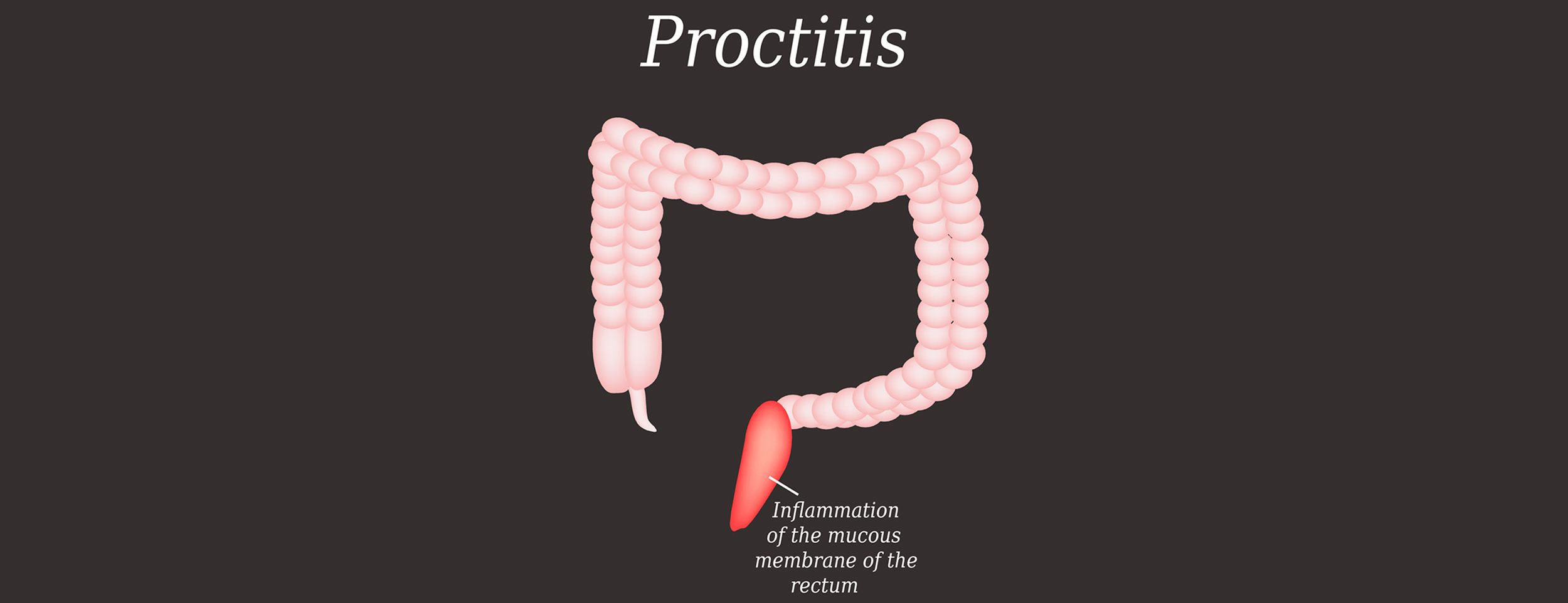 Other causes of pruritus and proctitis can be caused by hemorrhoids