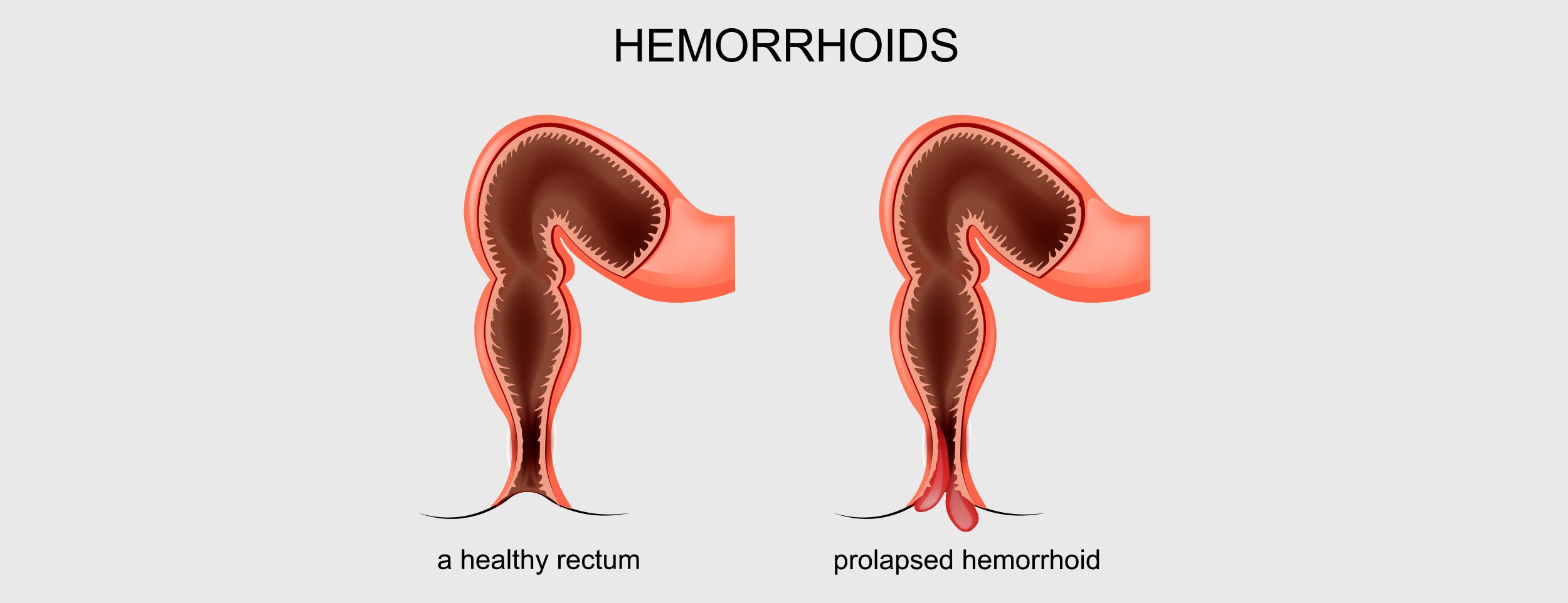 Prolapsing internal hemorrhoids causing internal pain and discomfort