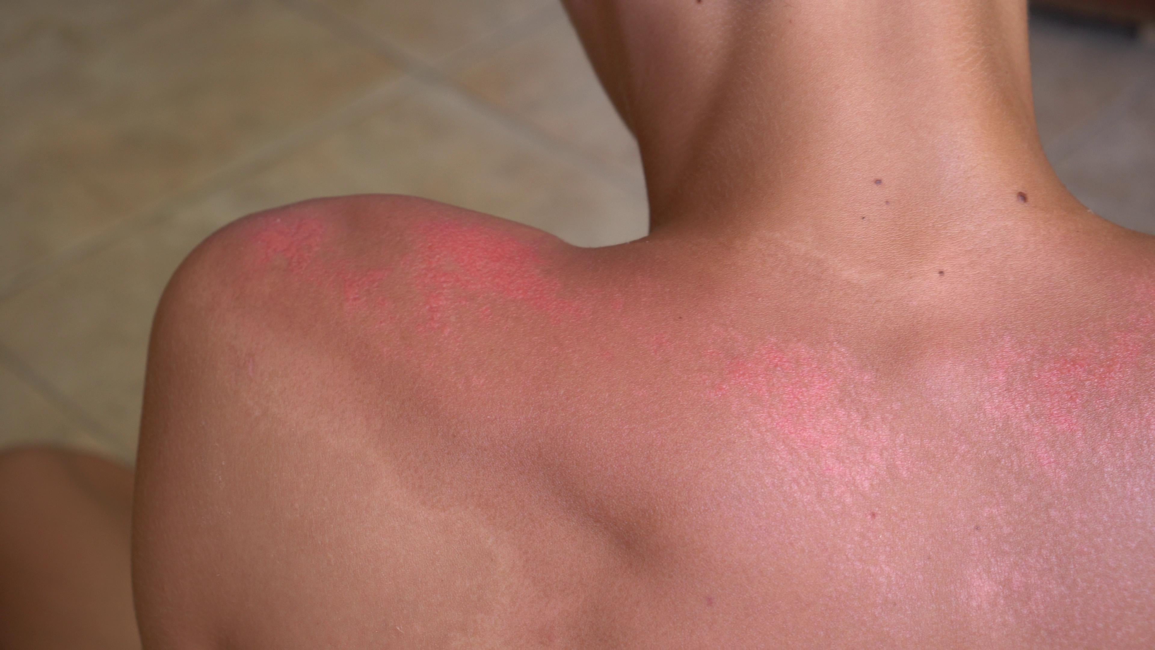 The Symptoms of Second-Degree Burns
