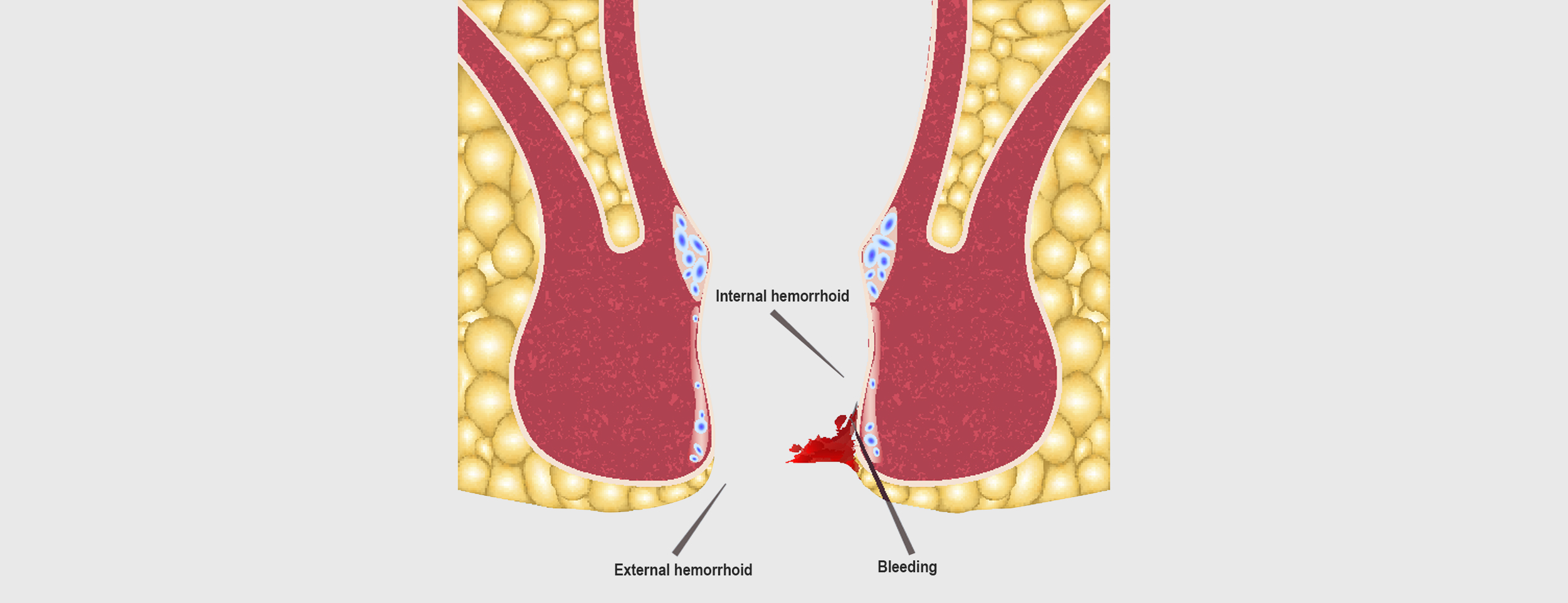 A hemorrhoid abscess is a bleed or discharge from the rectum