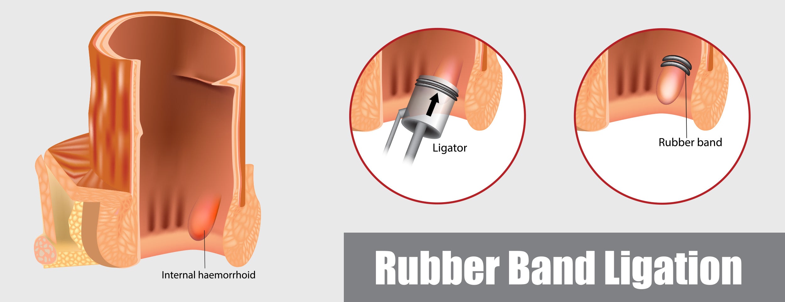 Hemorrhoids Rubber Banding Ligation Medical Procedure