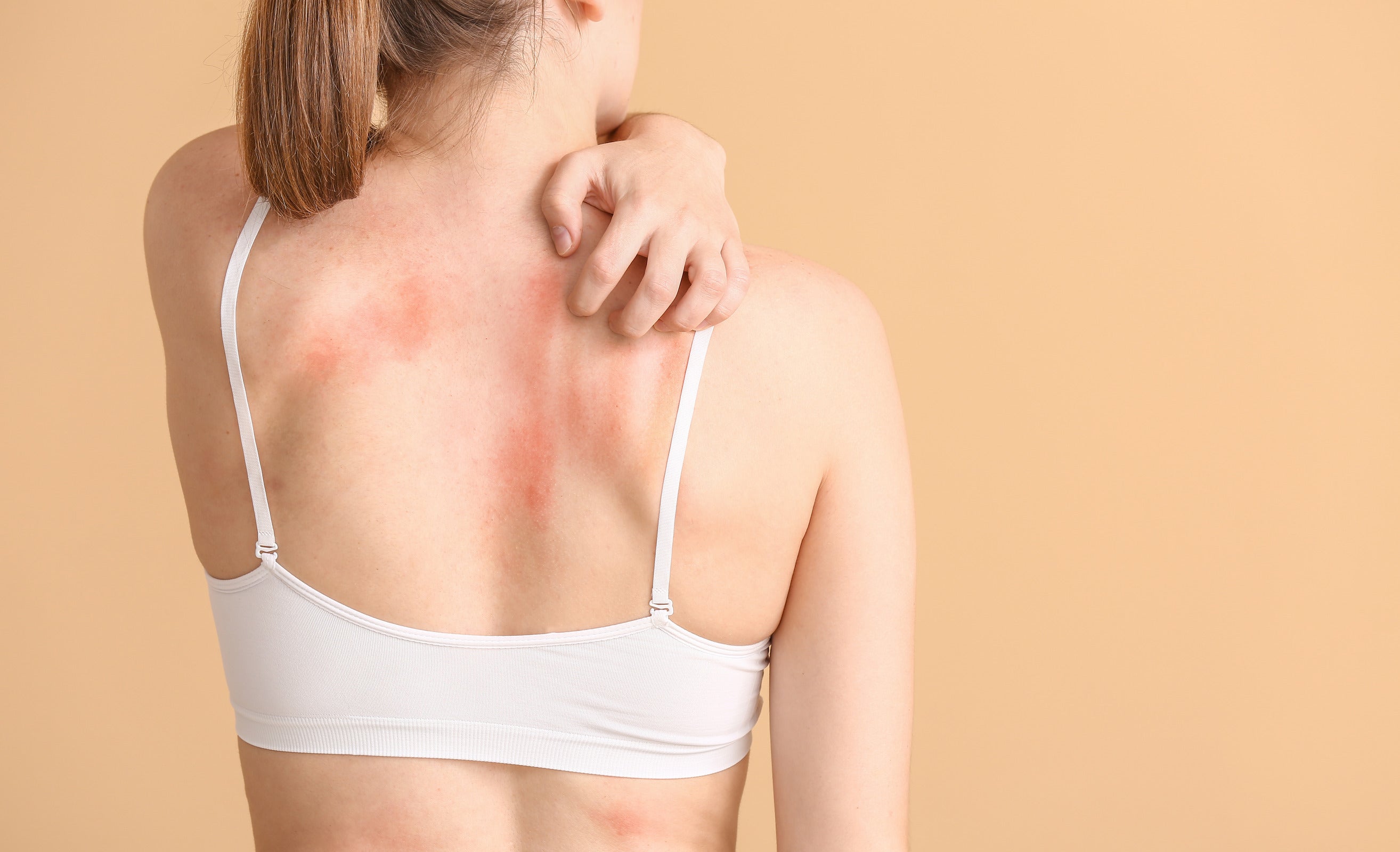 4 Signs and Symptoms of Skin Allergies