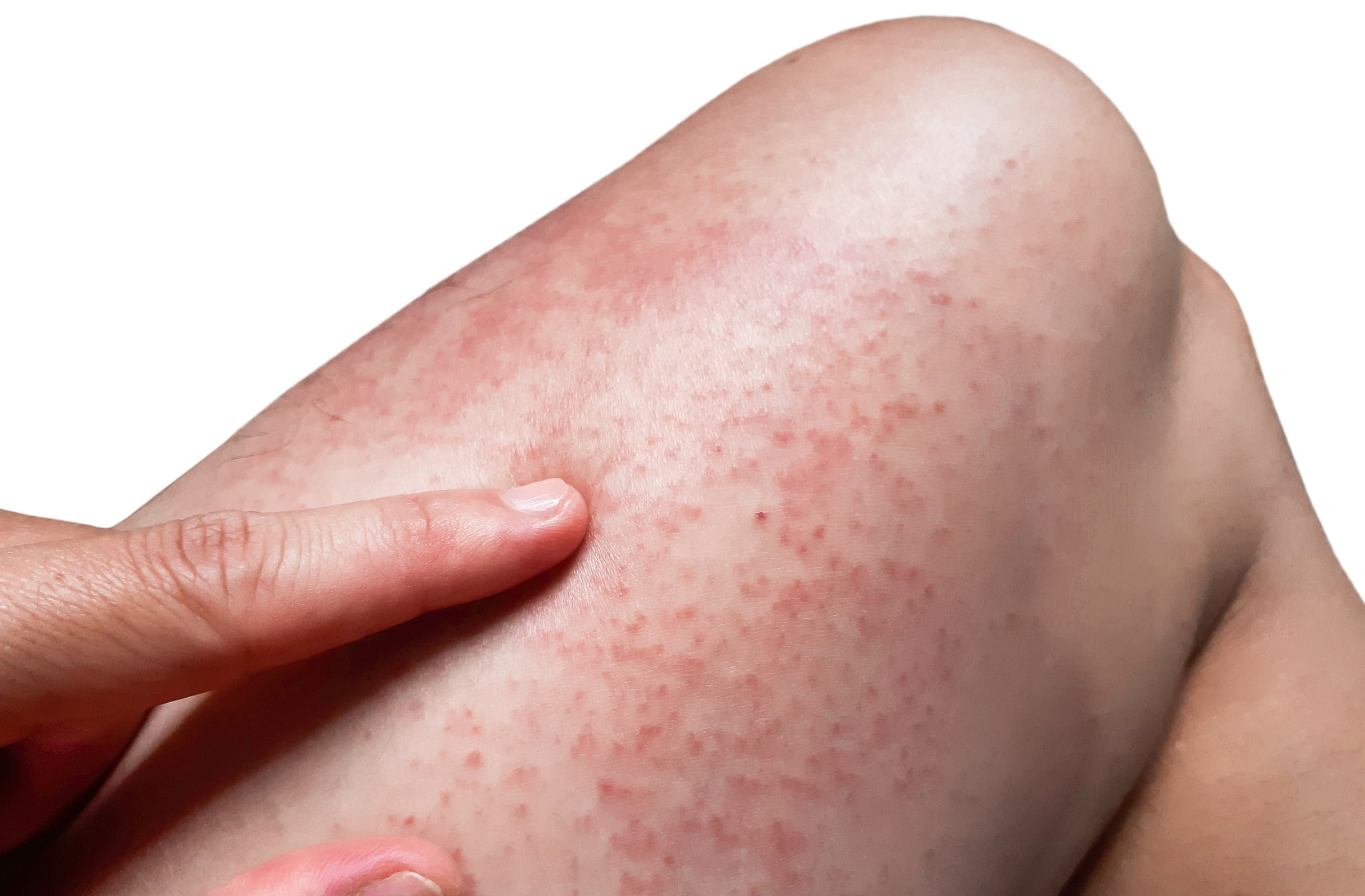 Skin irritation from Brazilian waxing