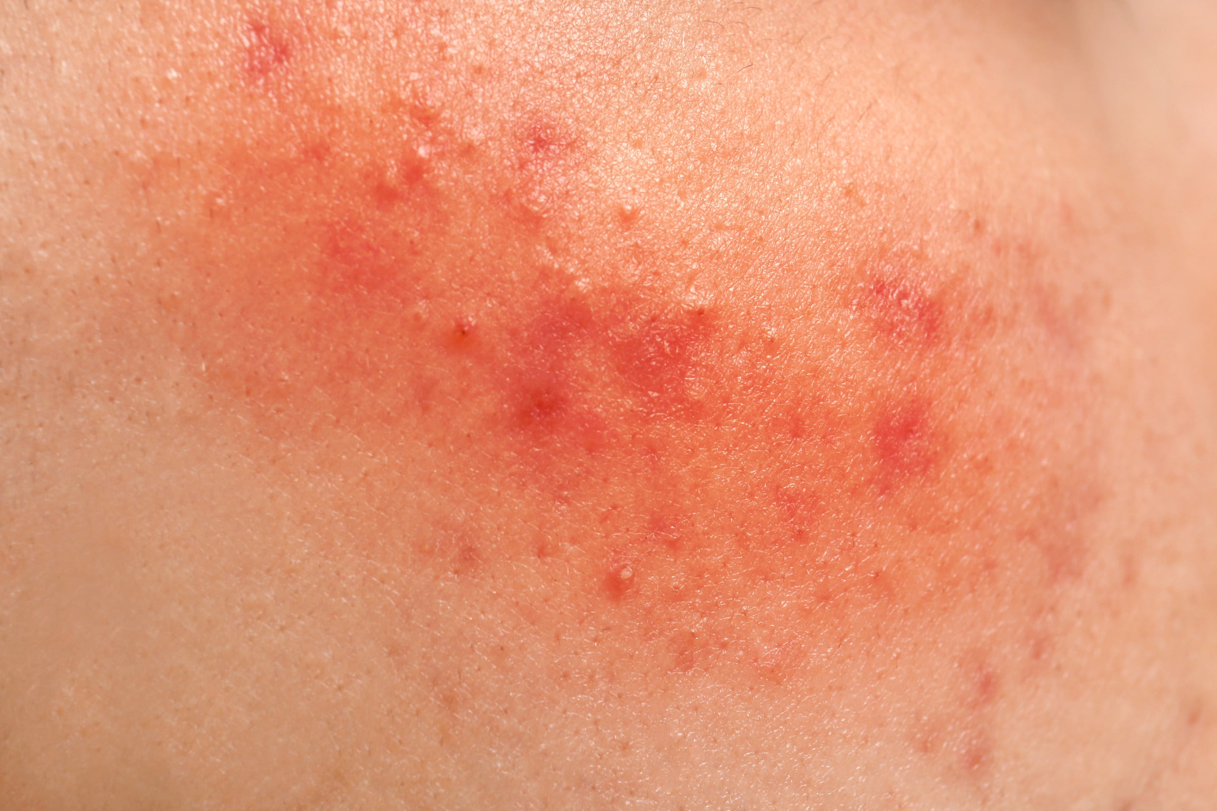 Skin irritation from over-the-counter hemorrhoid creams