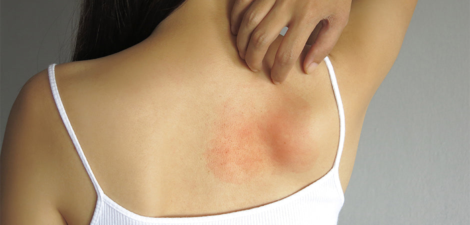 Right Time to Seek Medical Care for Stress Rash