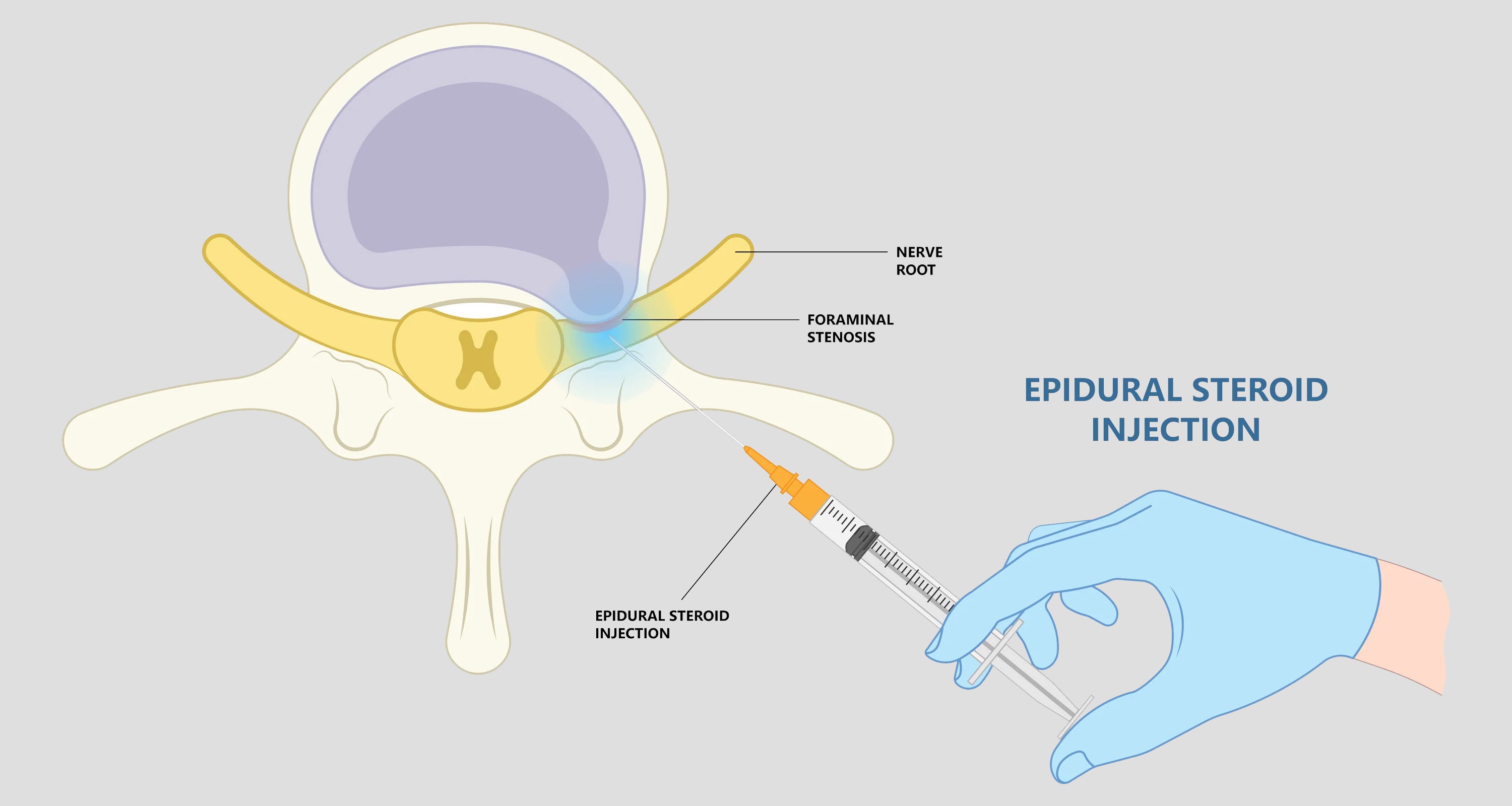 Anesthesia Layer Traverse in Subarachnoid Space