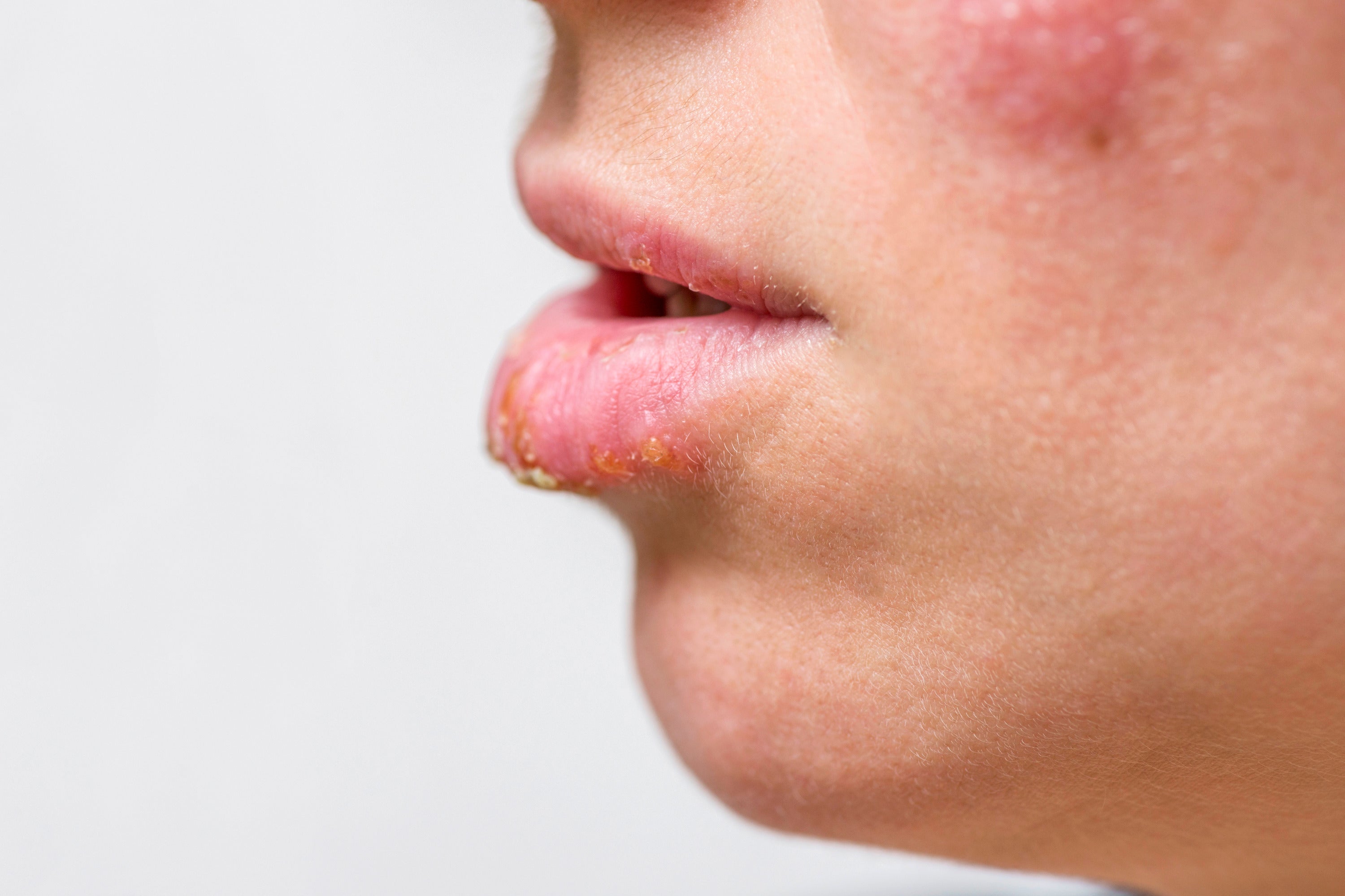 Understanding Sunburned Lip Complications