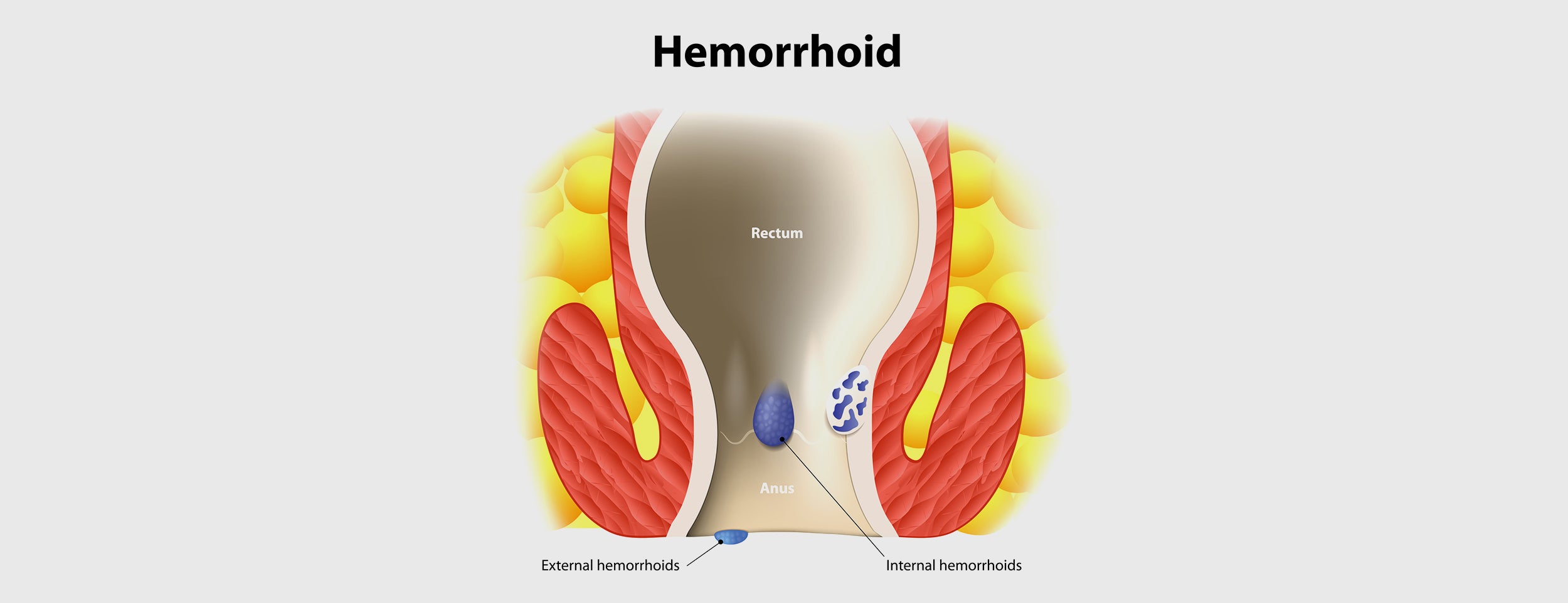 An infection in the anus caused by a hemorrhoid abscess