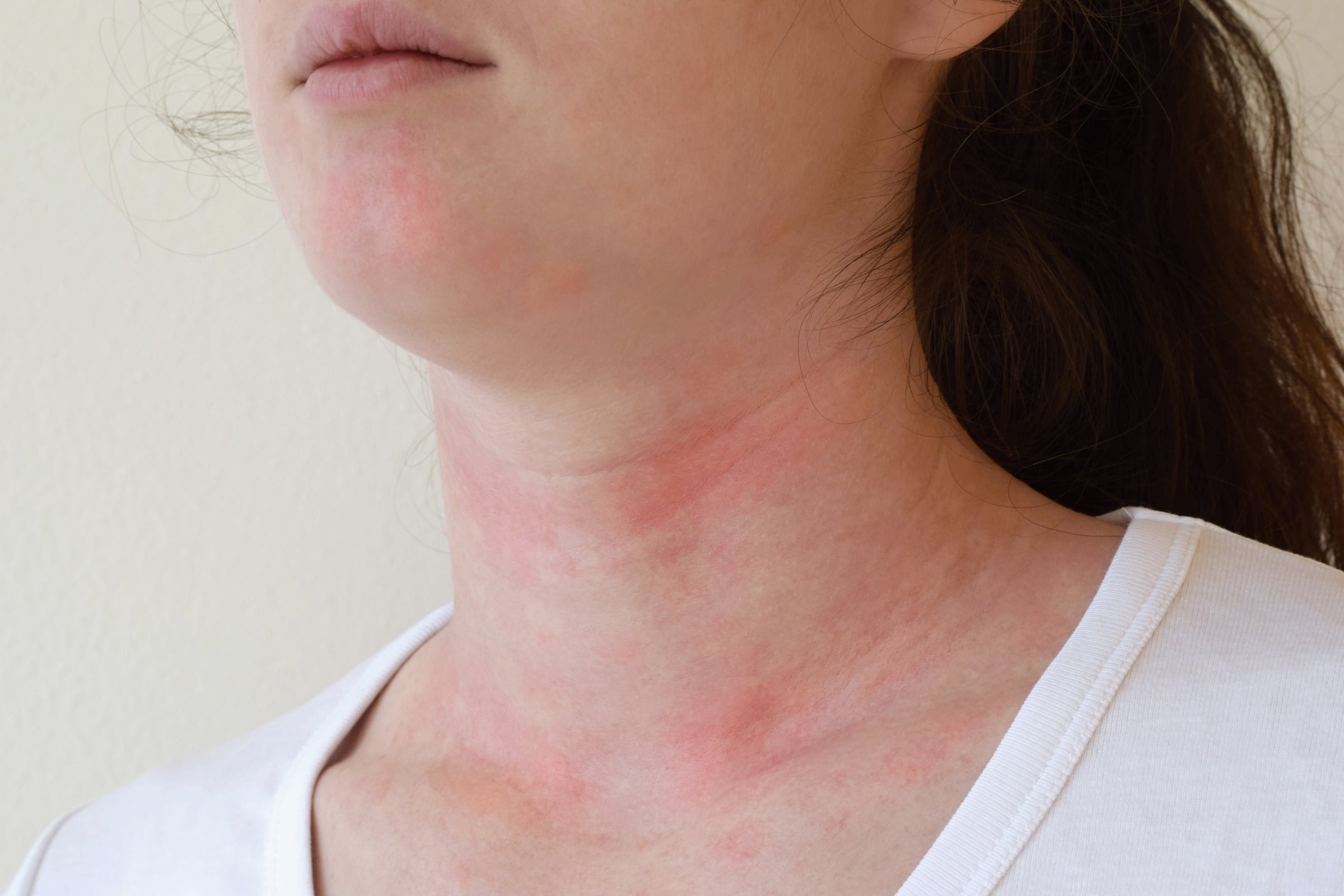 Allergic Skin Reactions Symptoms and Diagnosis