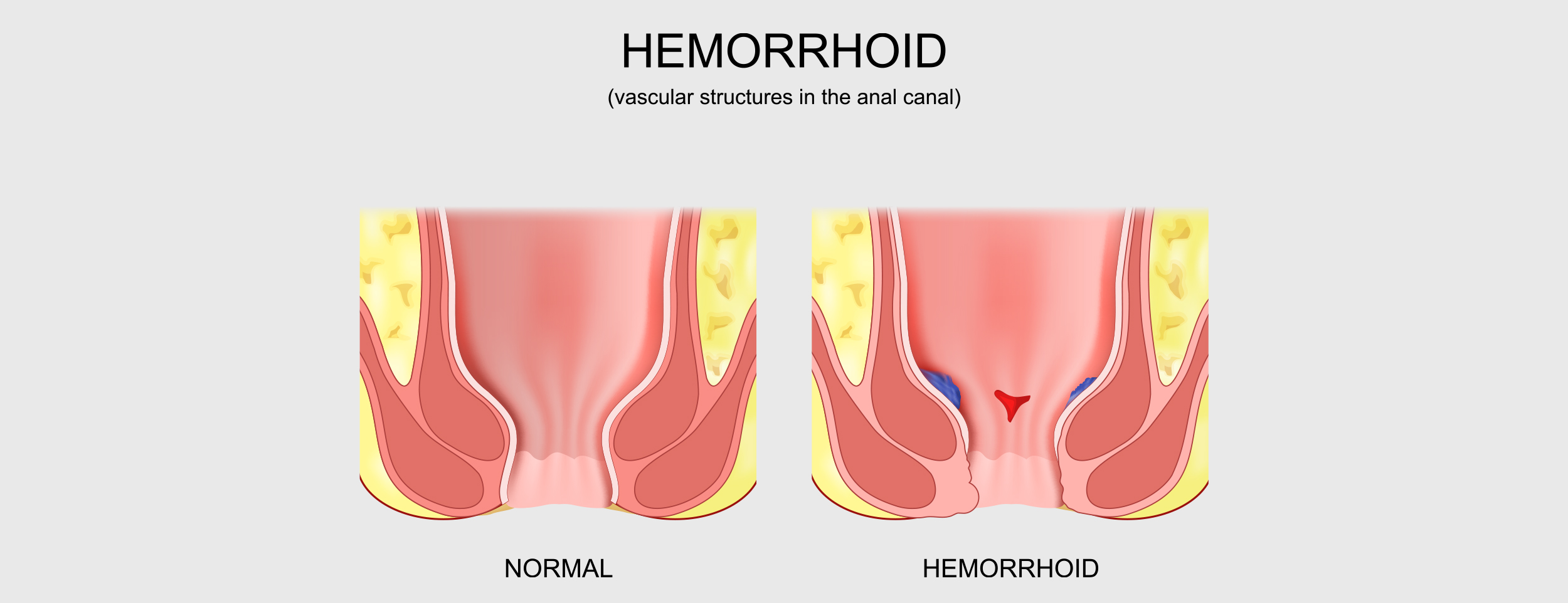 There are a number of symptoms associated with thrombosed hemorrhoids
