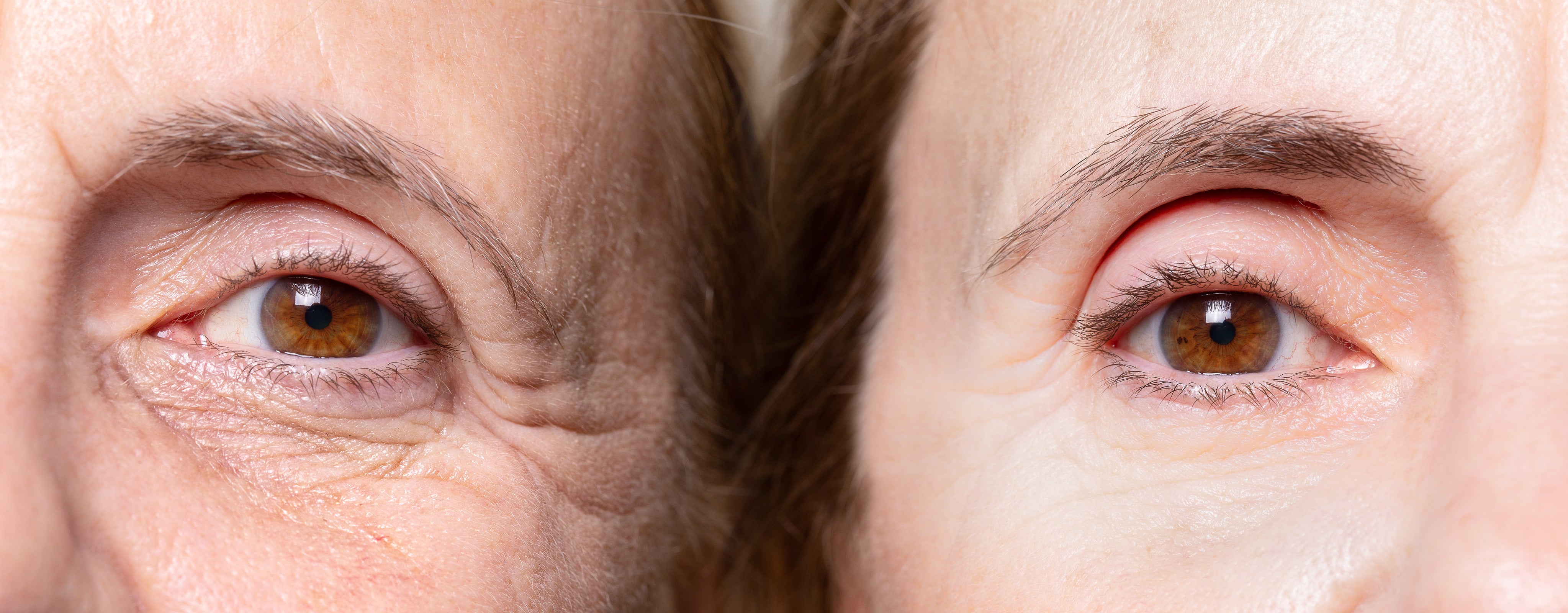 The duration of droopy eyelids after Botox treatment