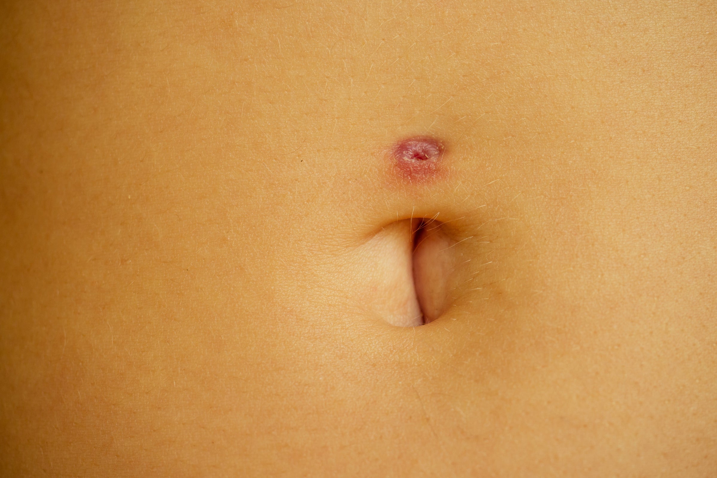 Tips for preventing belly button piercing