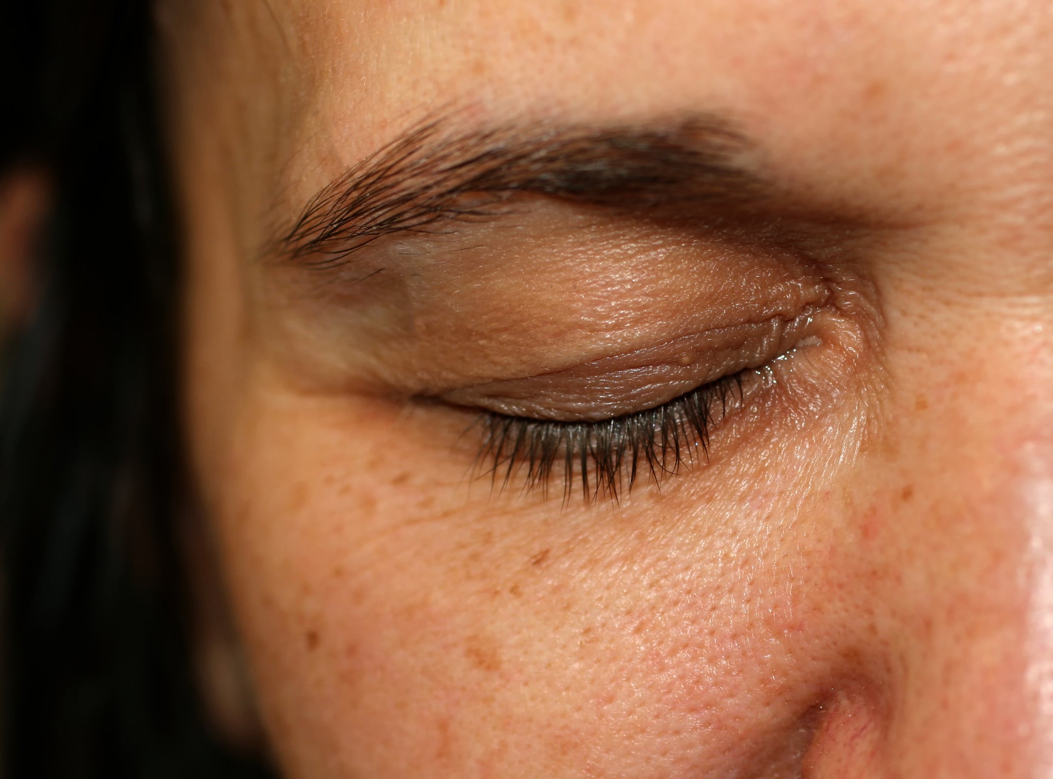 The duration of droopy eyelids after Botox varies between people