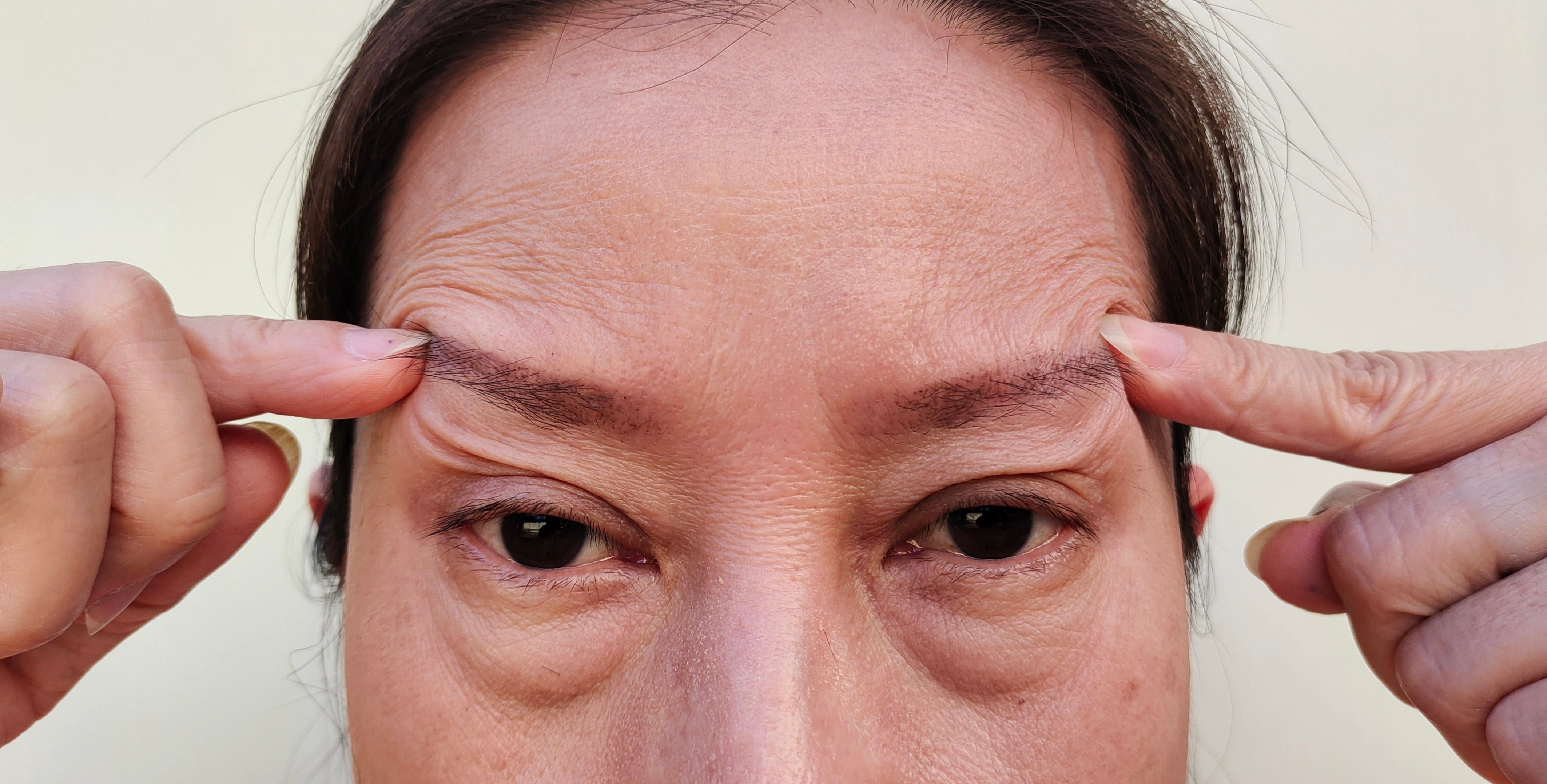 Weakness and neuromuscular changes caused by Botox over time