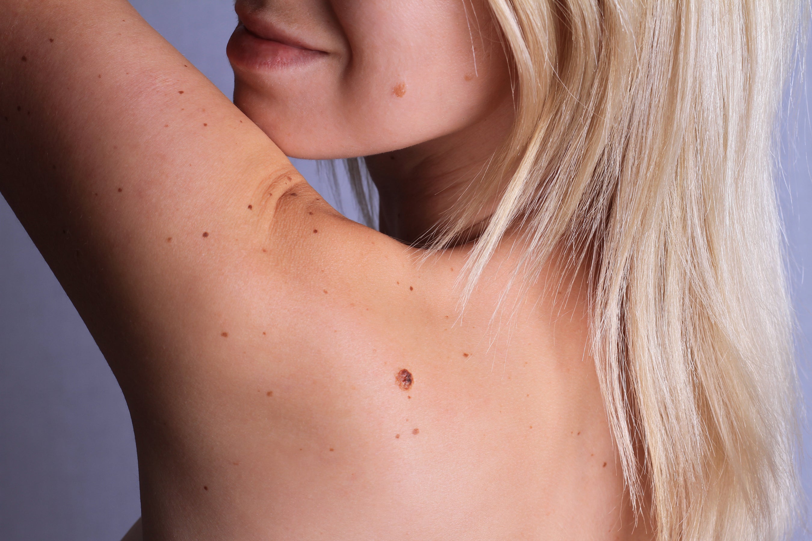 Here are the 16 fastest and most effective ways to remove a mole naturally