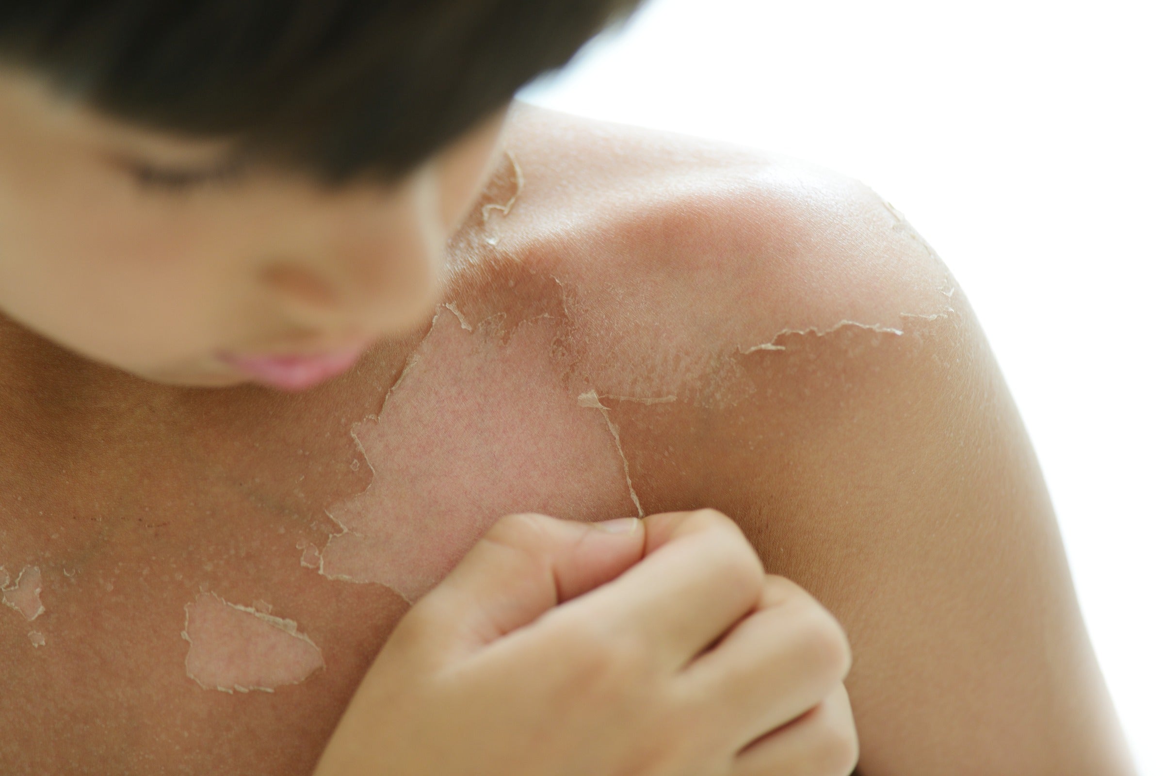 The 5 Factors to Consider When Going to the Hospital for a Sunburn