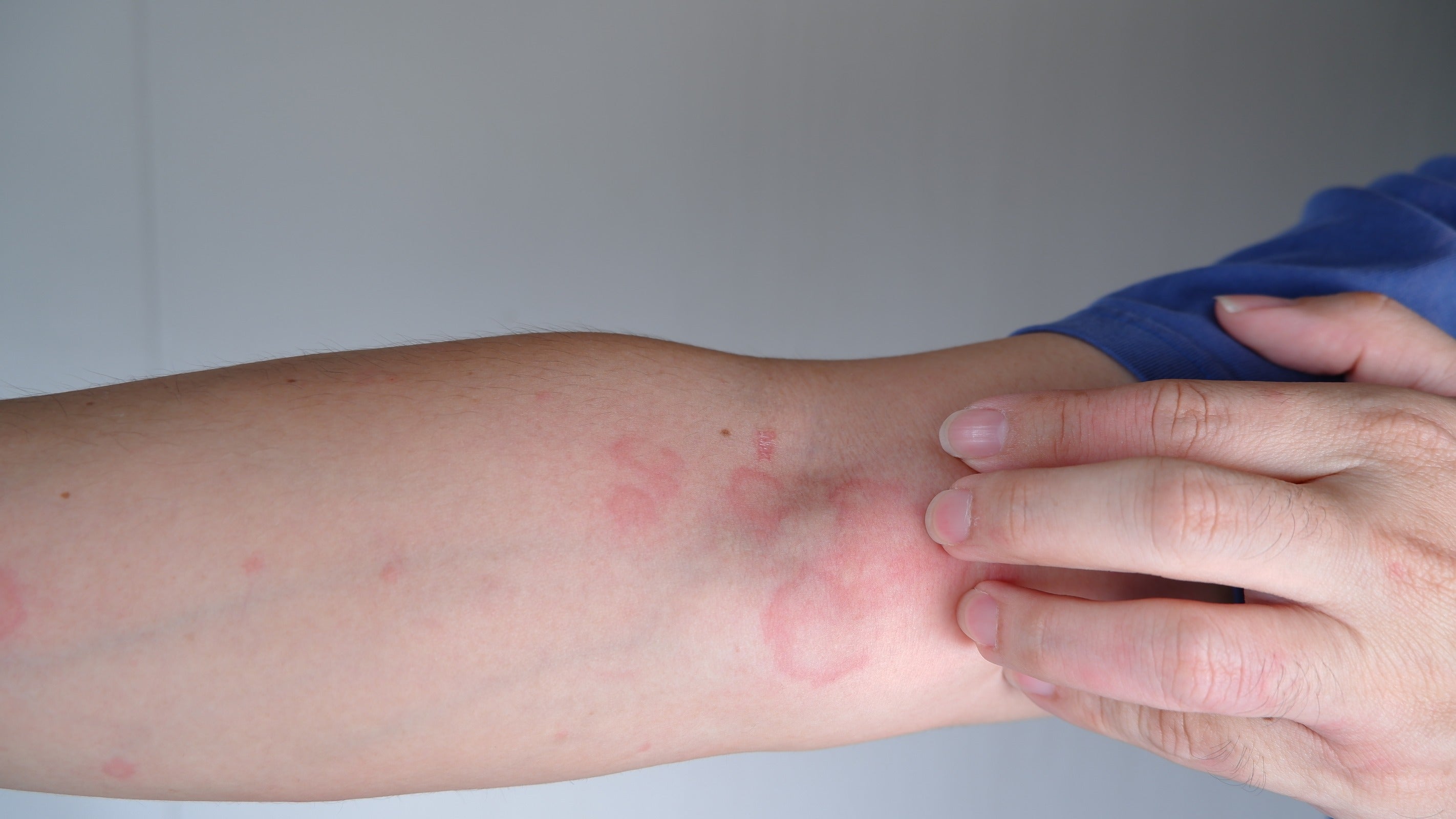 Precautions to Consider When Using Allergy Ointments