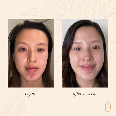 hormonal acne before and after