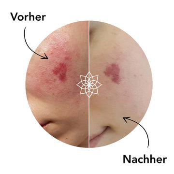 Dermaroller Vorher Nachher bei Rötungen