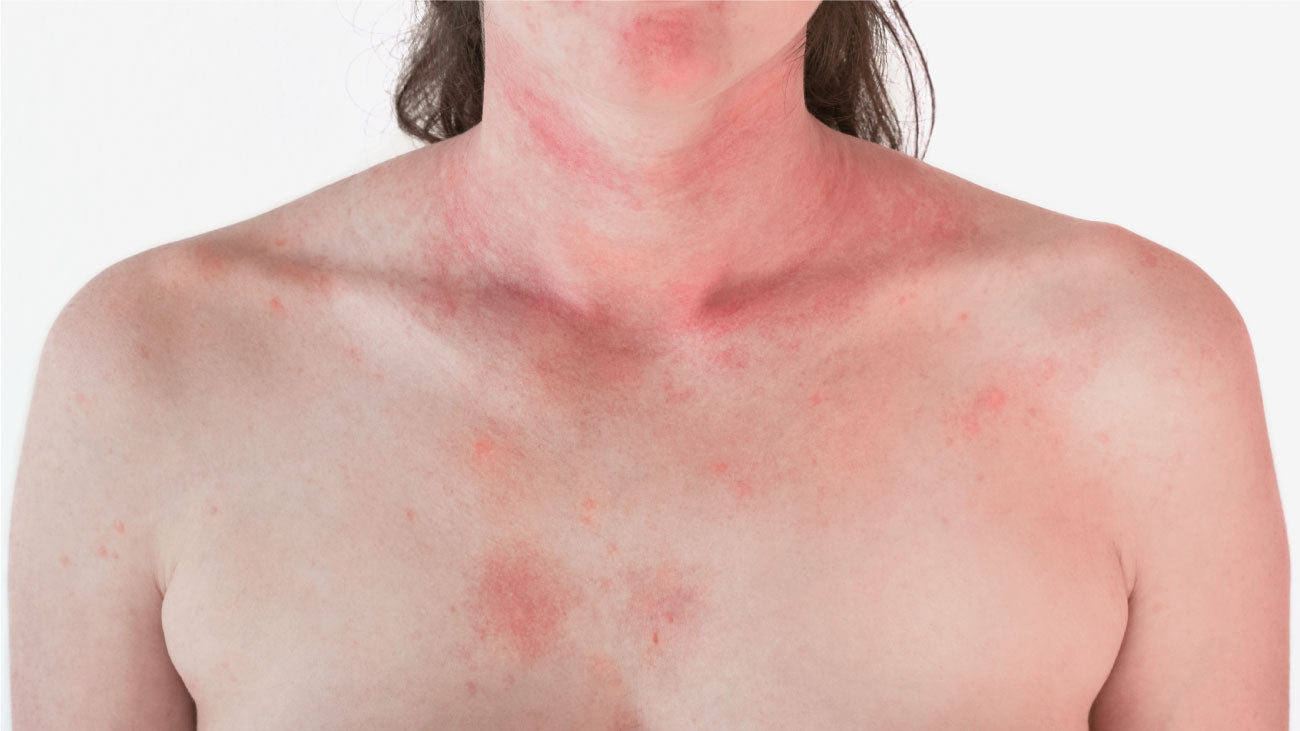 allergische Reaktion bei empfindlicher Haut