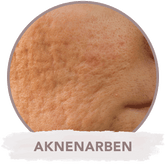 Microneedling gegen Aknenarben