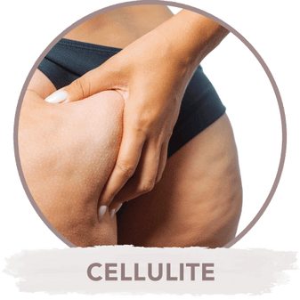 Cellulite