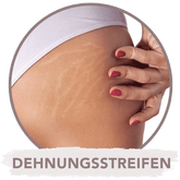 Microneedling gegen Dehnungsstreifen