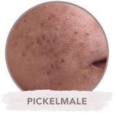 Microneedling gegen Pickelmale